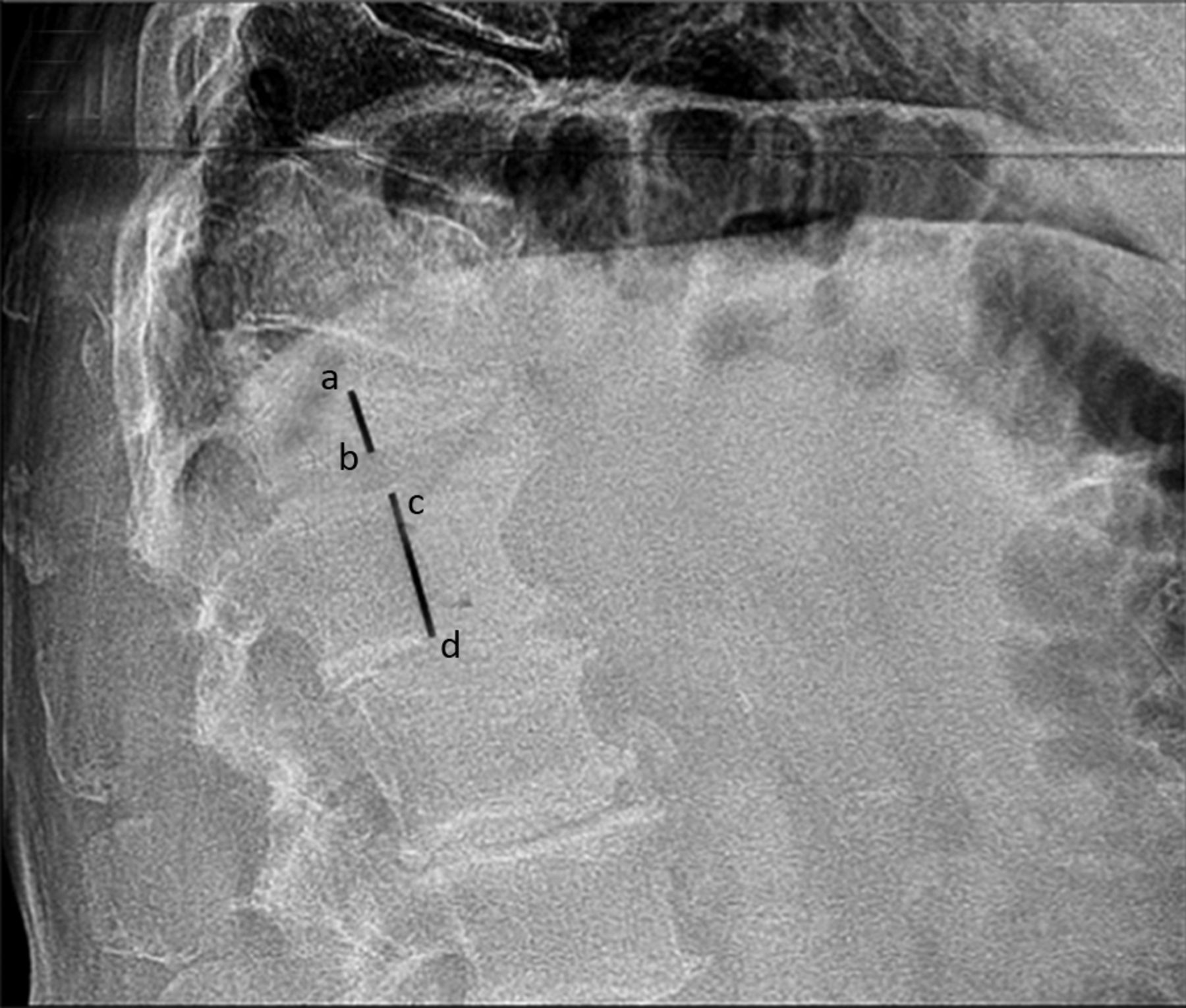 Comparison of unipedicular and bipedicular balloon kyphoplasty for the ...