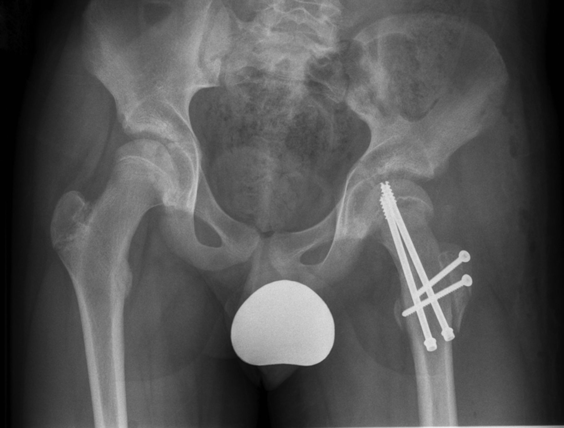 The treatment of severe slipped capital femoral epiphysis via the Ganz ...