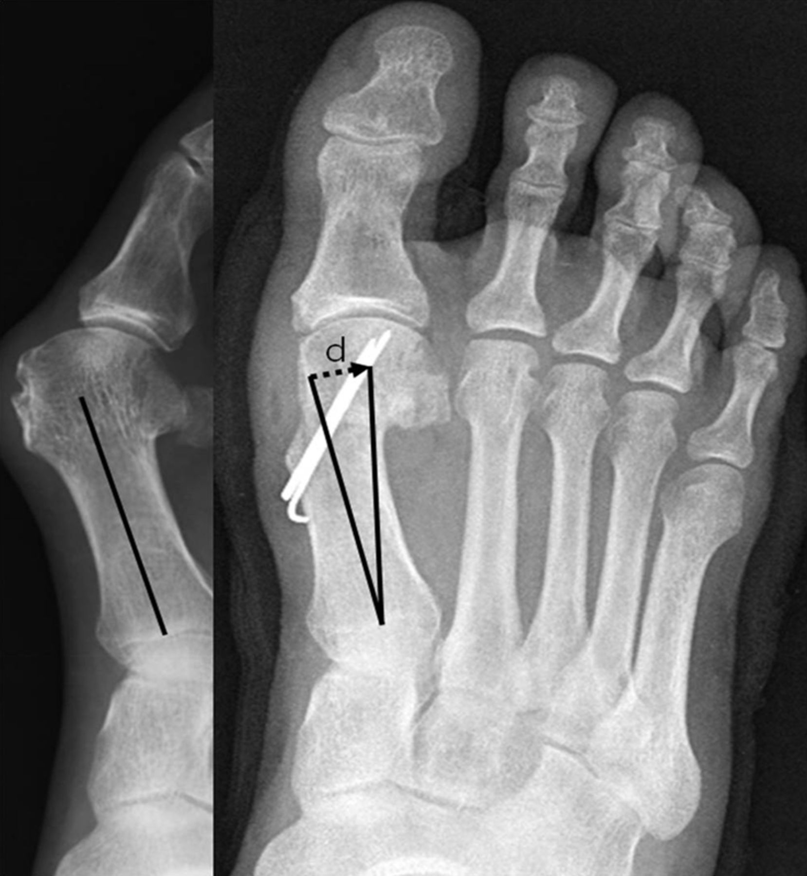 Comparison of outcomes between proximal and distal chevron osteotomy ...