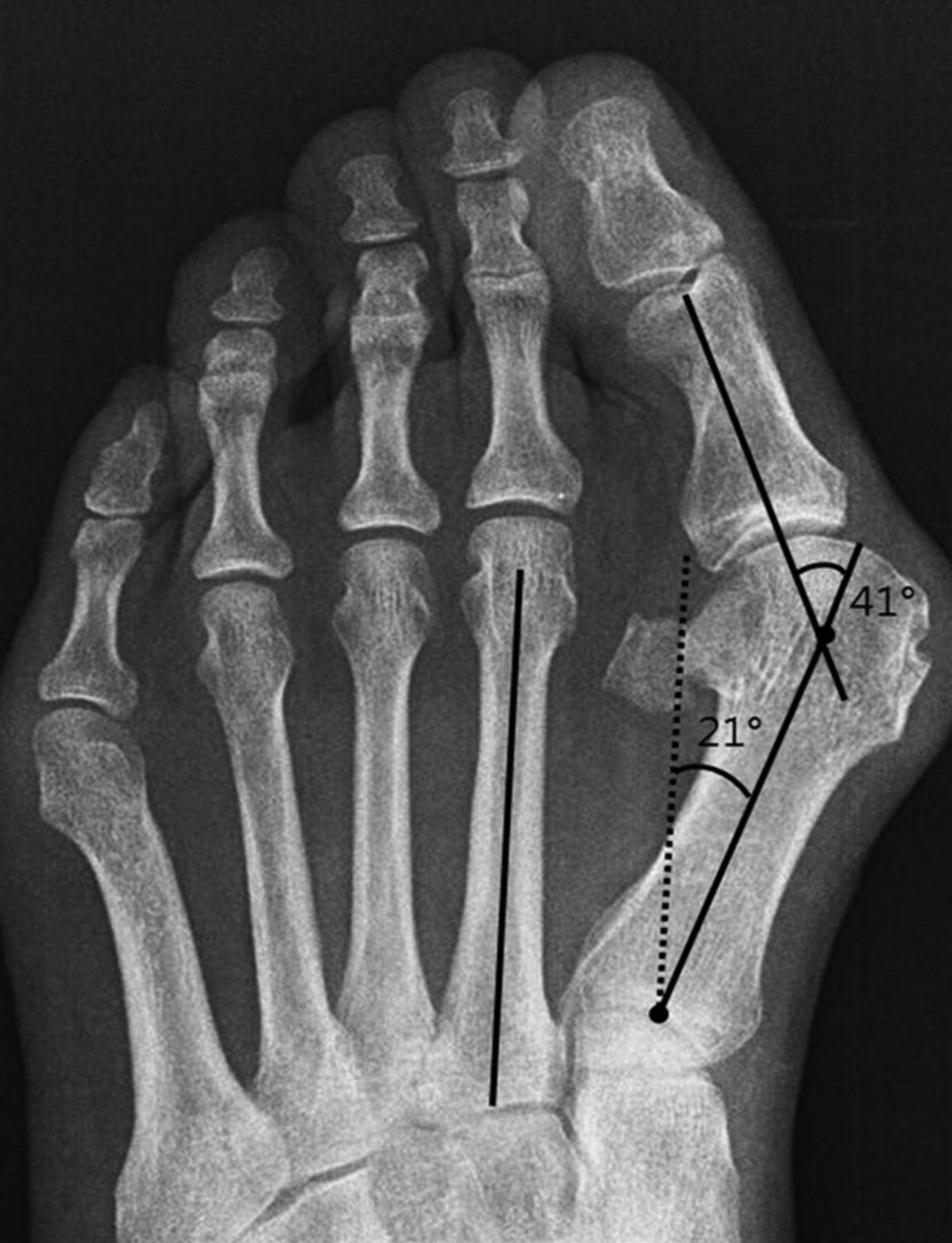 Comparison of outcomes between proximal and distal chevron osteotomy ...