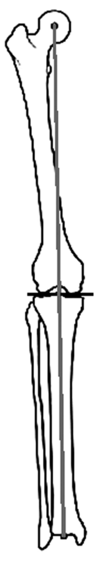 Lateral compartment osteoarthritis of the knee | Bone & Joint