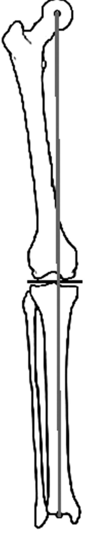 Lateral compartment osteoarthritis of the knee | Bone & Joint