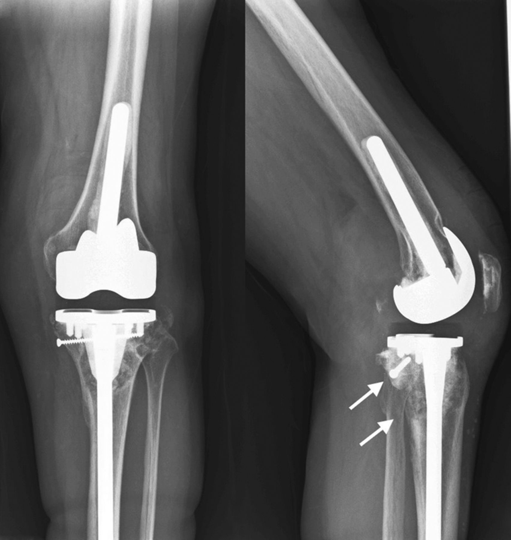 Reconstruction Using Femoral Head Allograft In Revision Total Knee Replacement Bone Joint