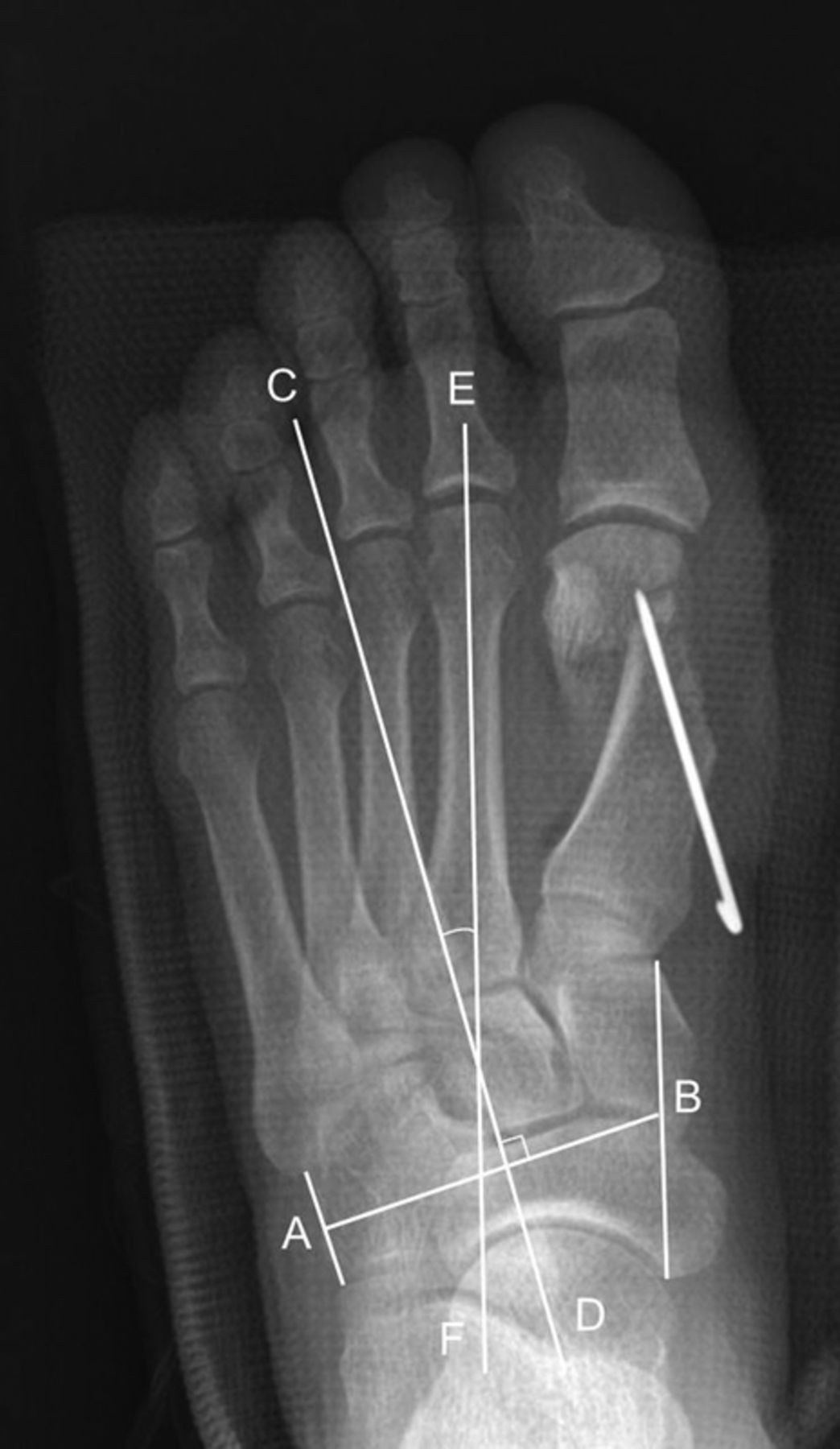 A comparison of proximal and distal chevron osteotomy for the ...