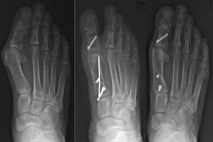 Additional surgical factors affecting the recurrence of hallux valgus ...