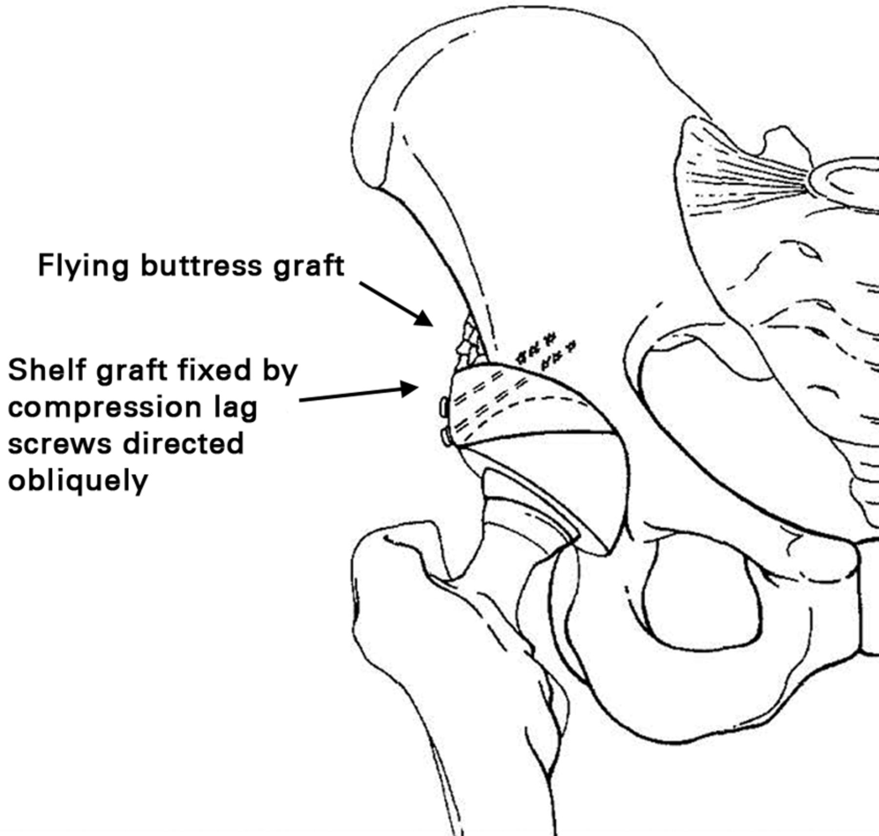 Revision of the acetabular component in dysplastic hips previously ...