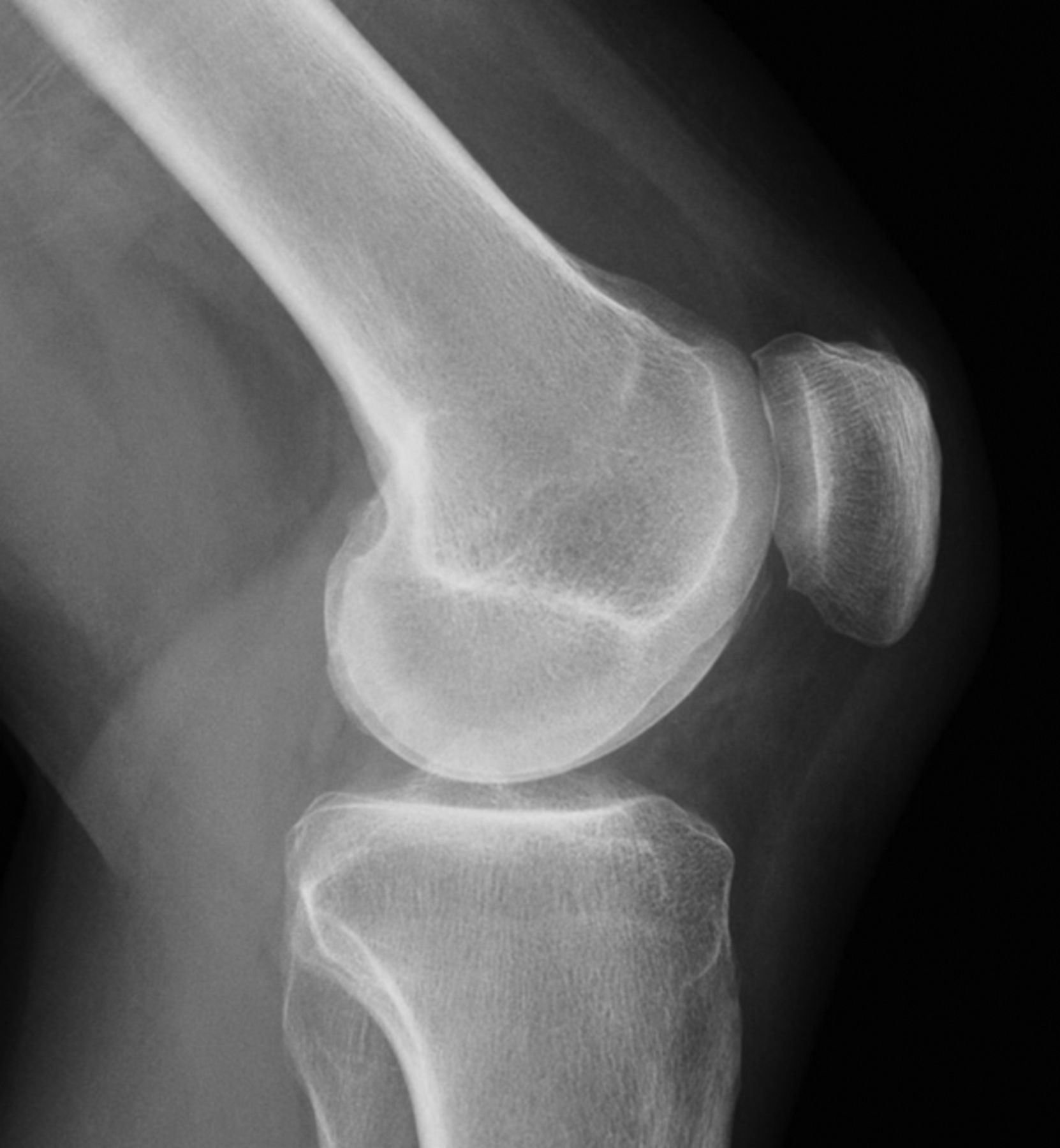 Early revisions of the Femoro-Patella Vialla joint replacement | Bone ...