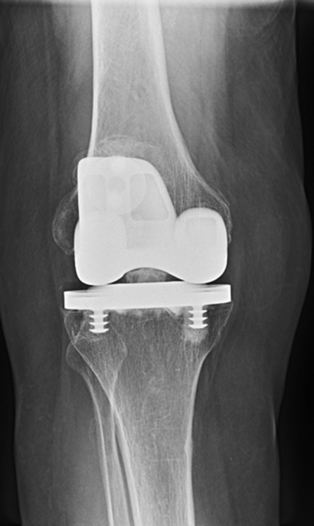 Total knee replacement with retention of both cruciate ligaments | Bone ...