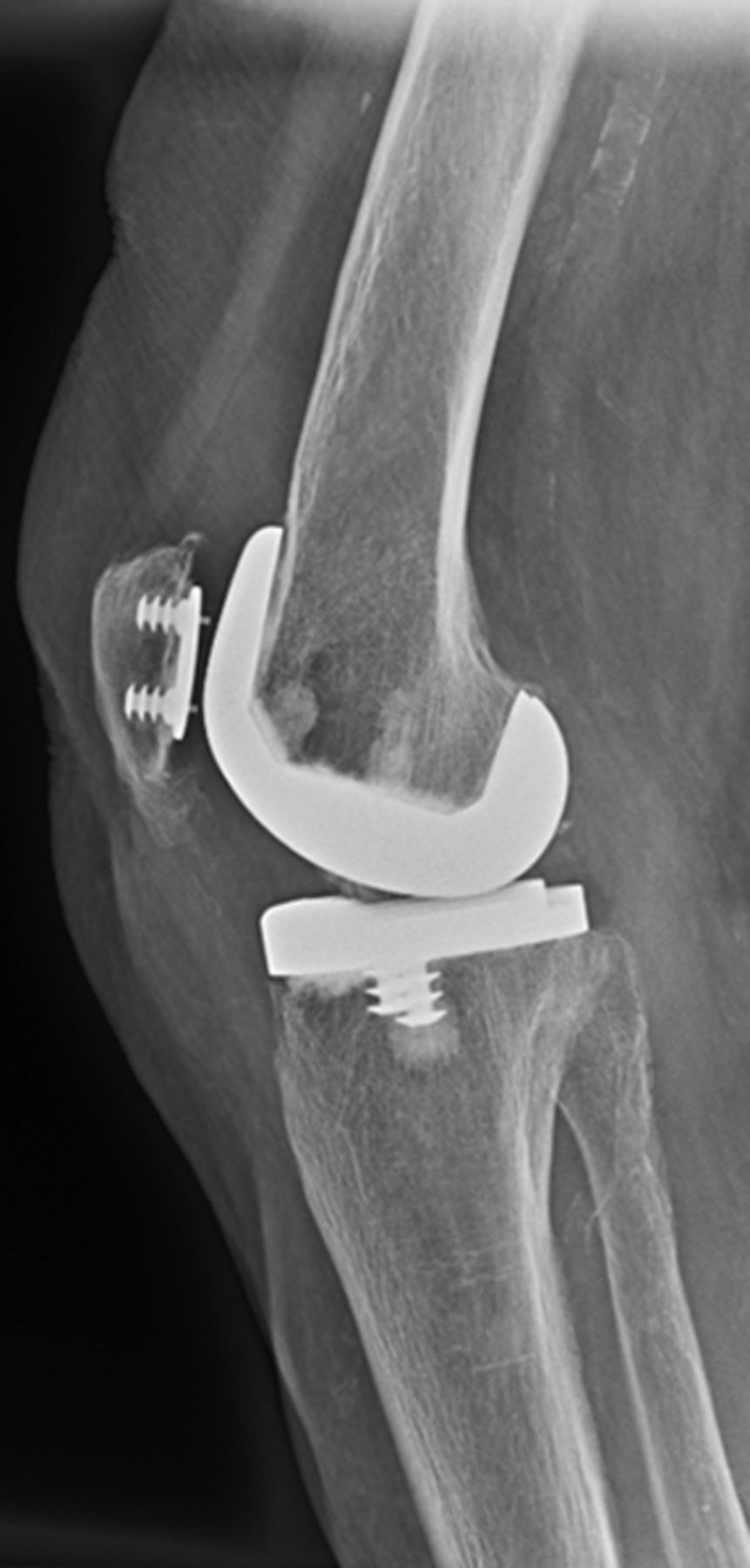 Total Knee Replacement With Retention Of Both Cruciate Ligaments 