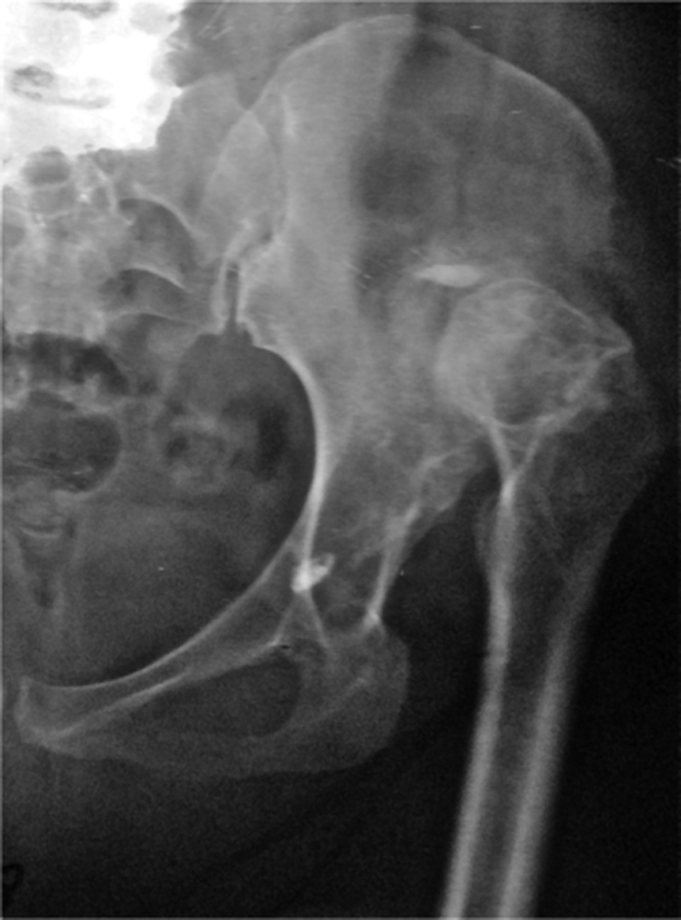 Acetabular reconstruction in patients with low and high dislocation ...