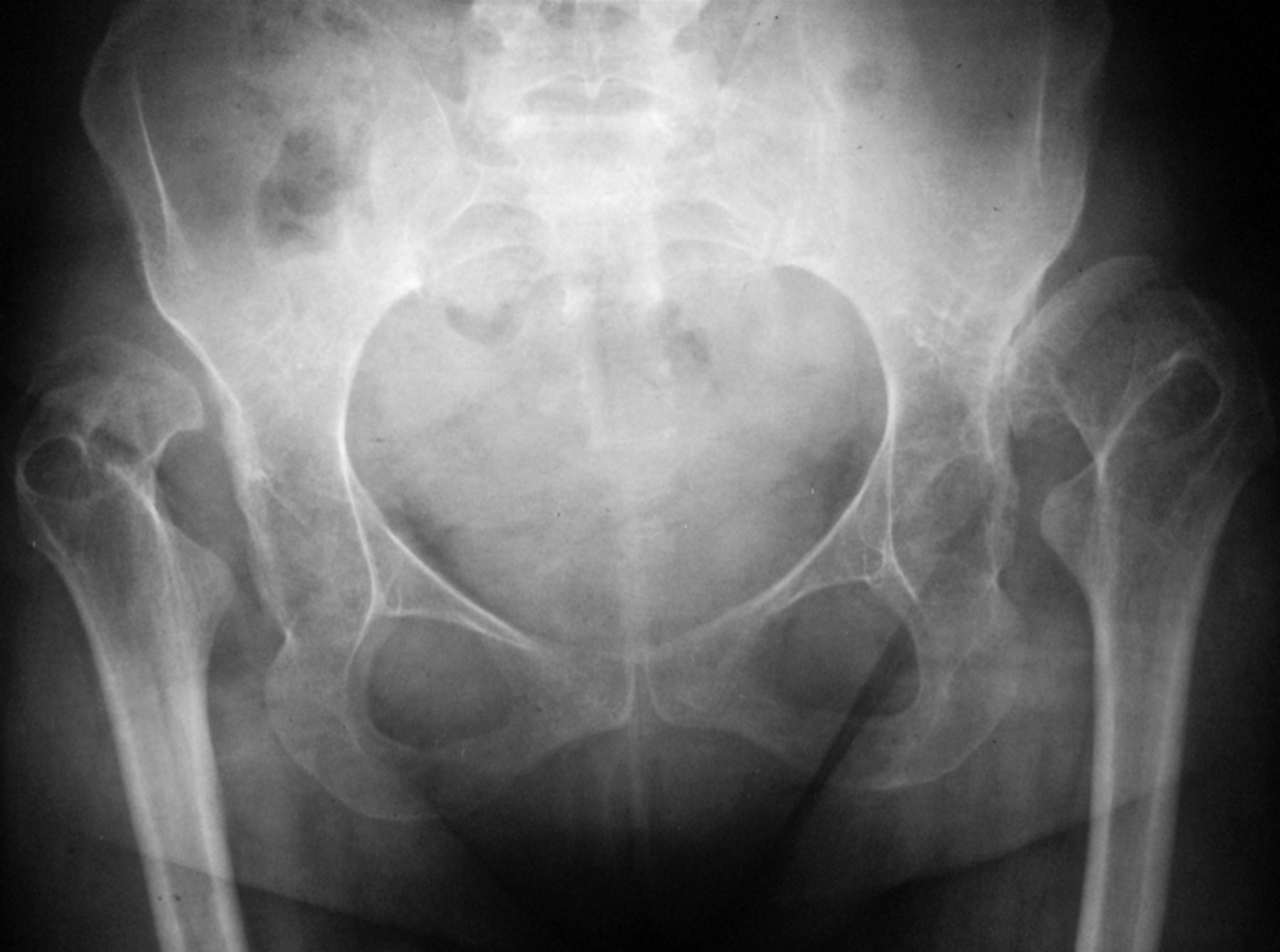 Acetabular Reconstruction In Patients With Low And High Dislocation