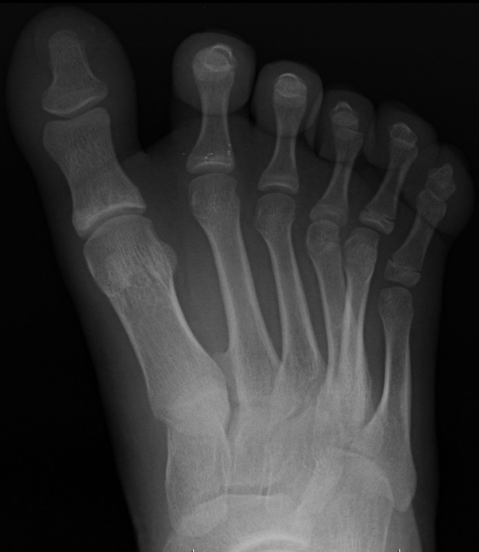 Metatarsal transfer for the treatment of post-axial metatarsal-type ...