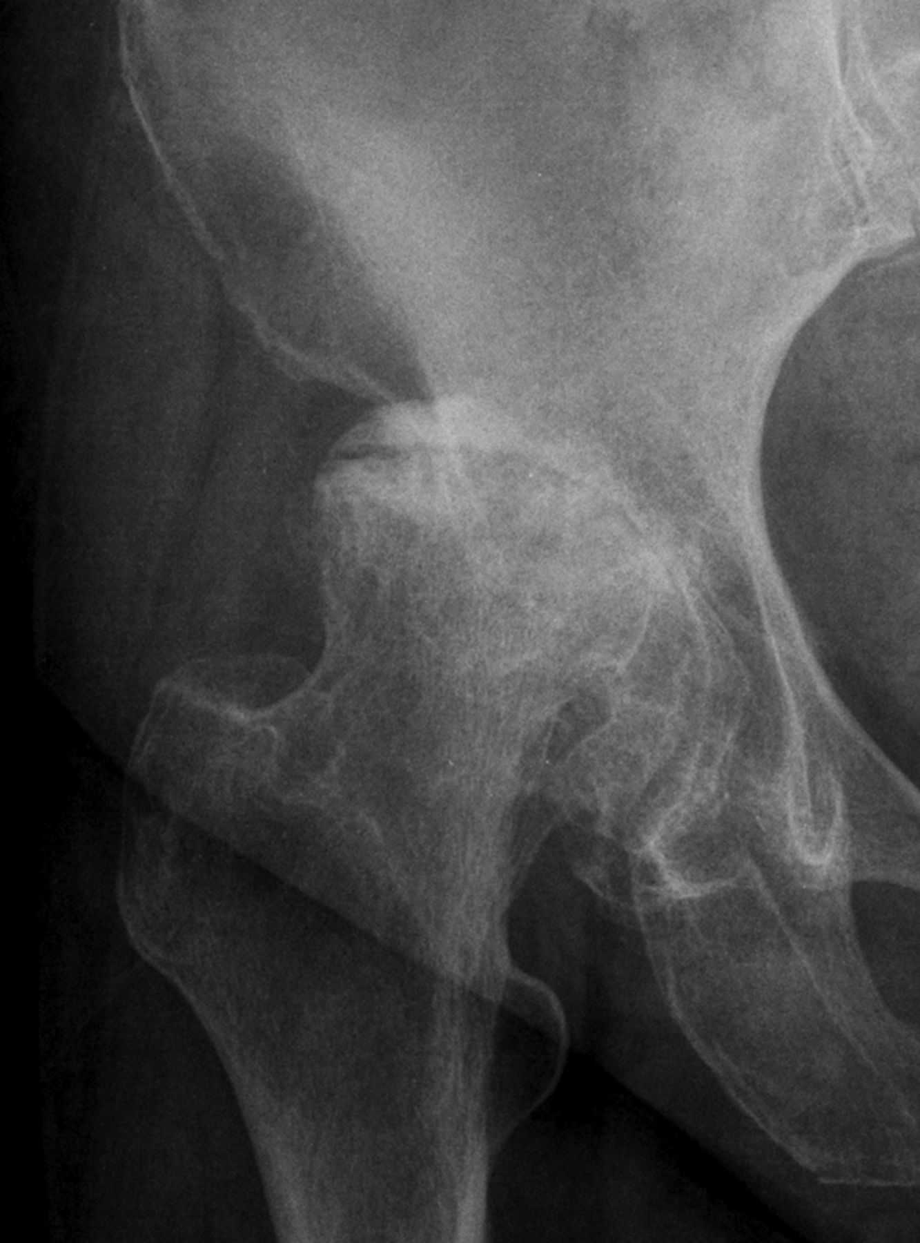 Total hip replacement for developmental dysplasia of the hip with more ...