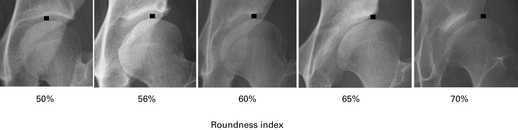 Femoral head deformity and severity of acetabular dysplasia of the hip ...