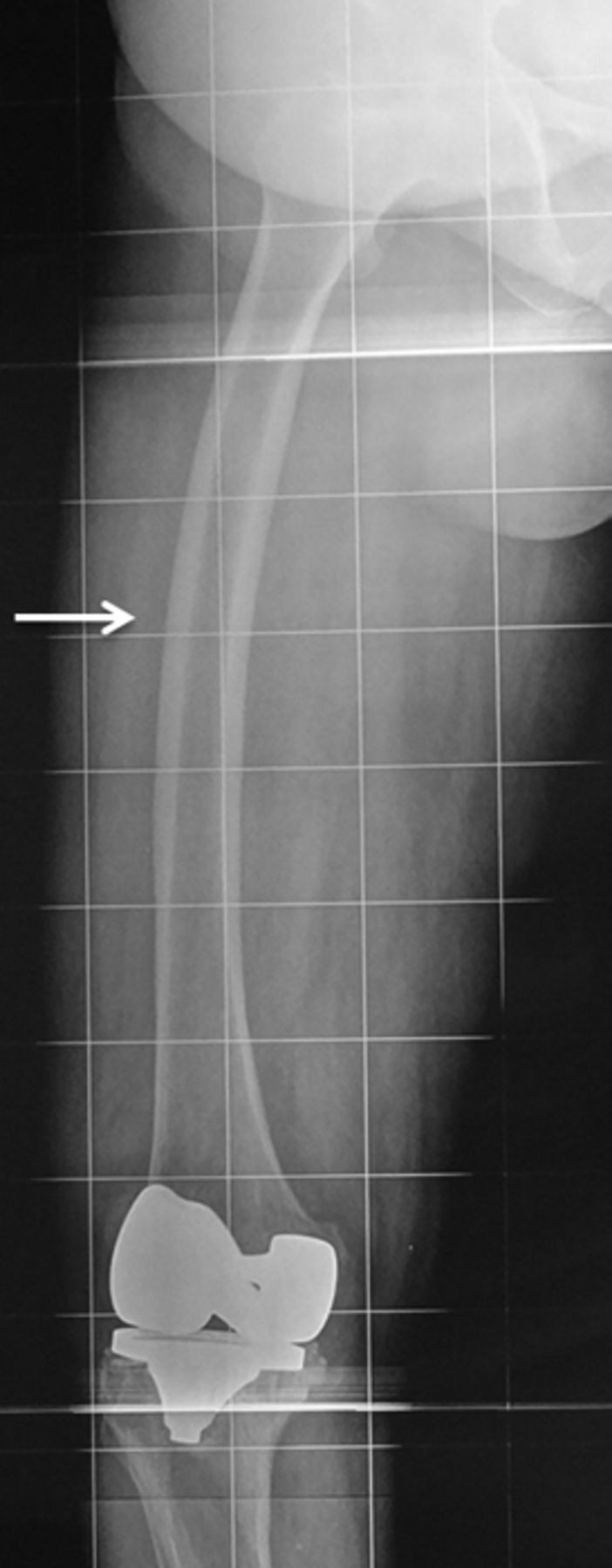 Cemented Stems | Bone & Joint