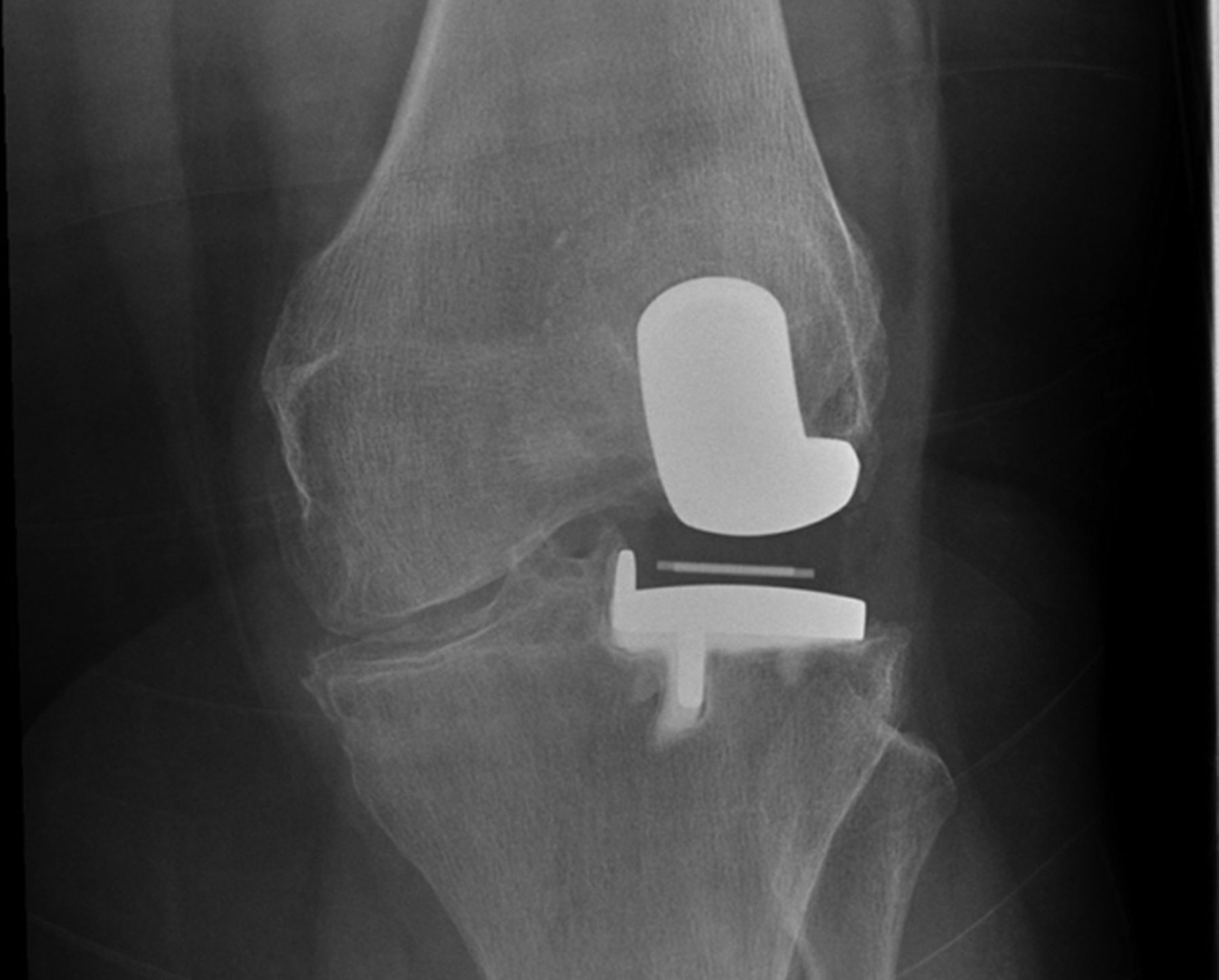 The Mid-term Outcomes Of The Oxford Domed Lateral Unicompartmental Knee 