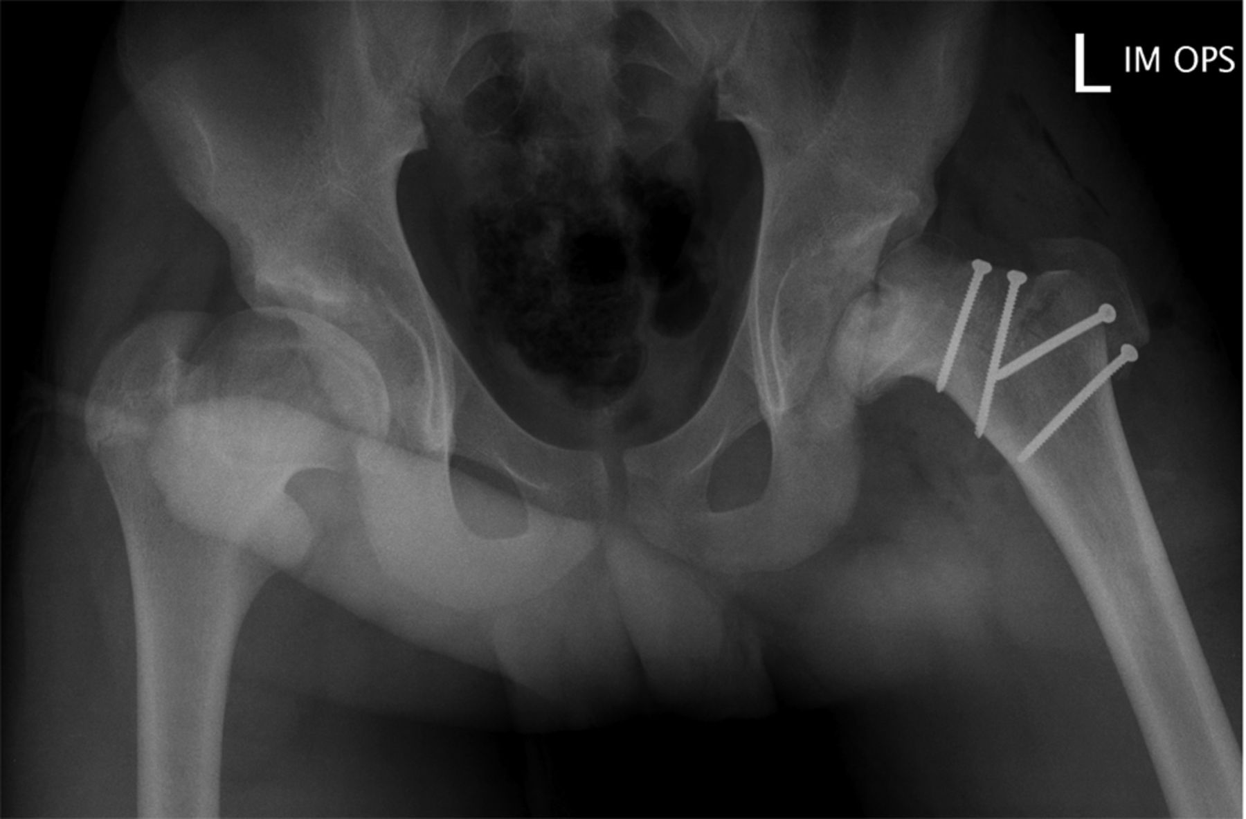 The evolution and concepts of joint-preserving surgery of the hip ...