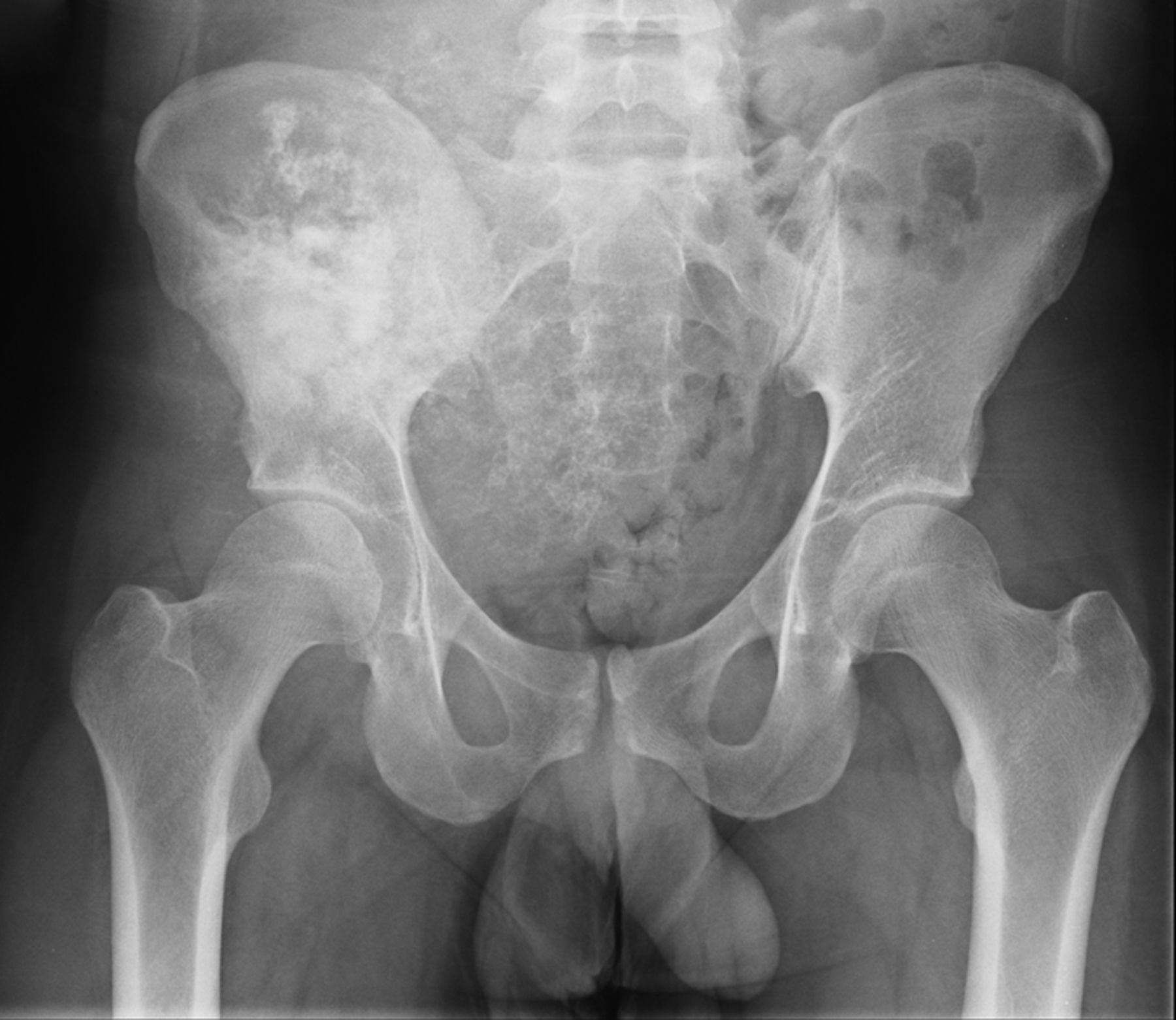 The use of extracorporeally irradiated autografts in pelvic ...