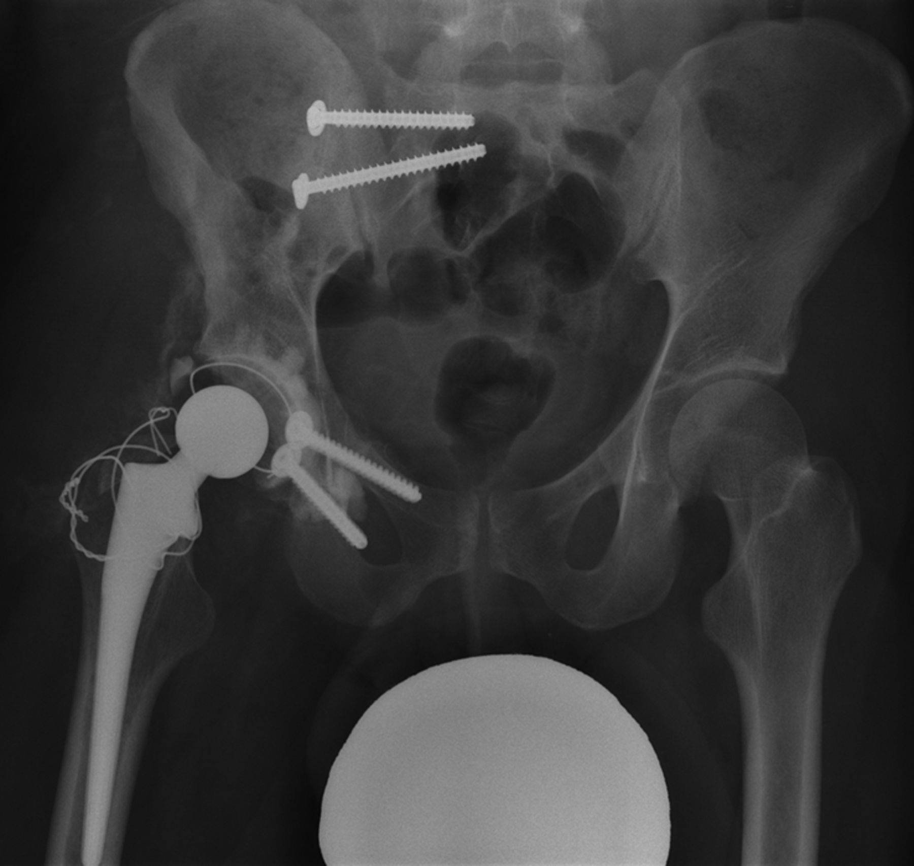 The Use Of Extracorporeally Irradiated Autografts In Pelvic Reconstruction Following Tumour 6033