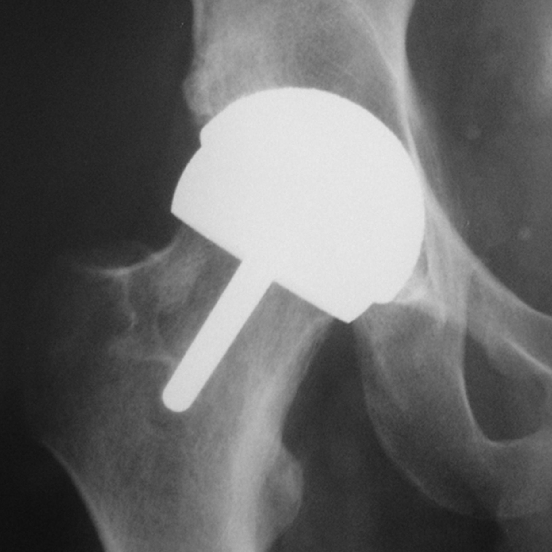 Birmingham Hip Resurfacing Complications