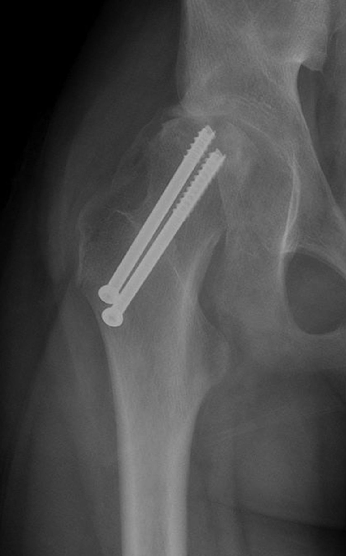 Femoral neck fractures Bone & Joint