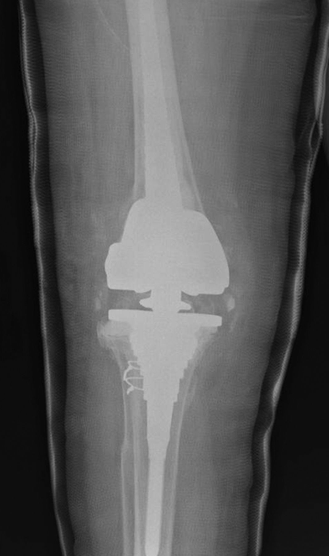 The multiply-operated total knee replacement patient | Bone & Joint