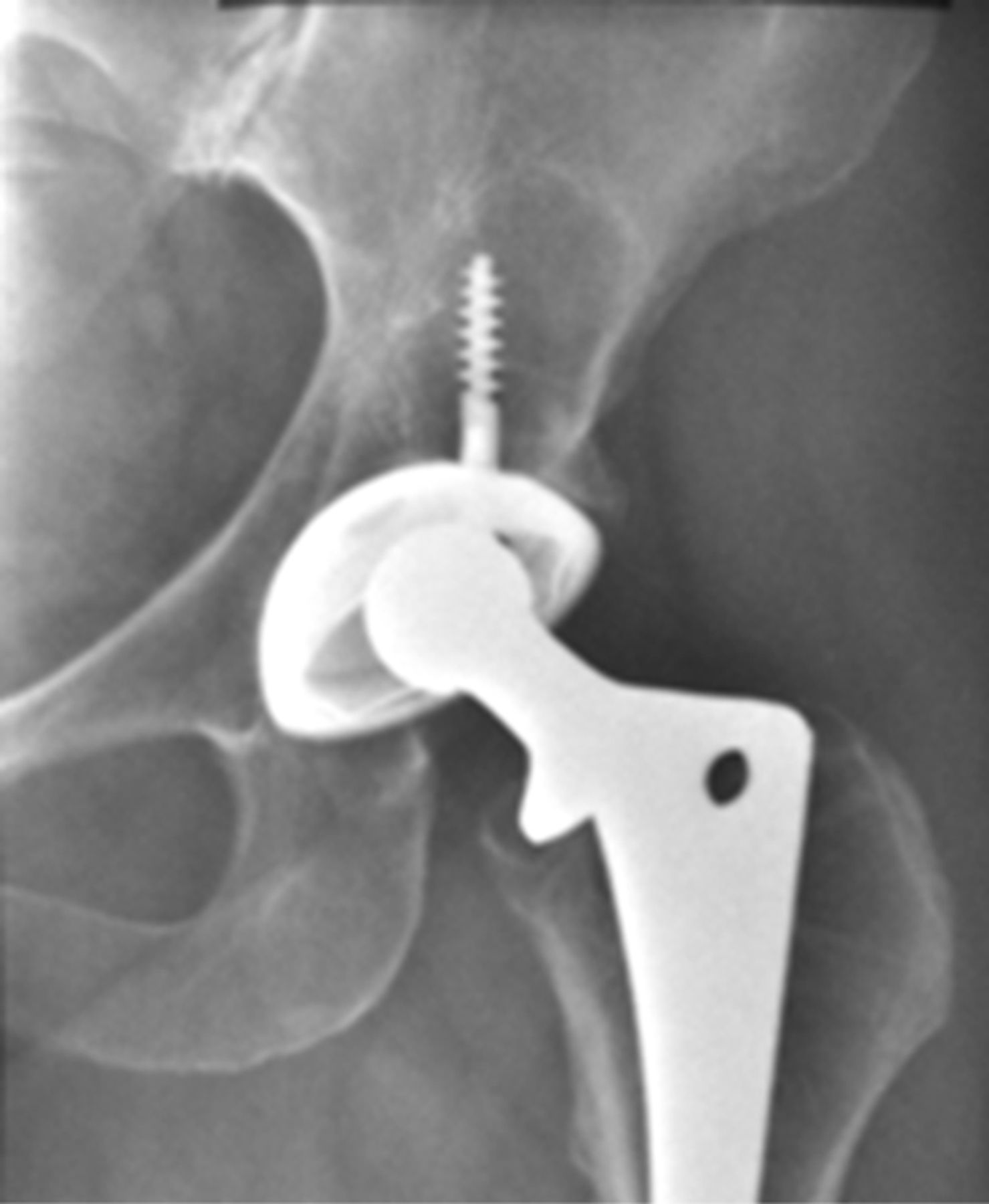 The Revision Acetabulum – Allograft And Bone Substitutes | Bone & Joint