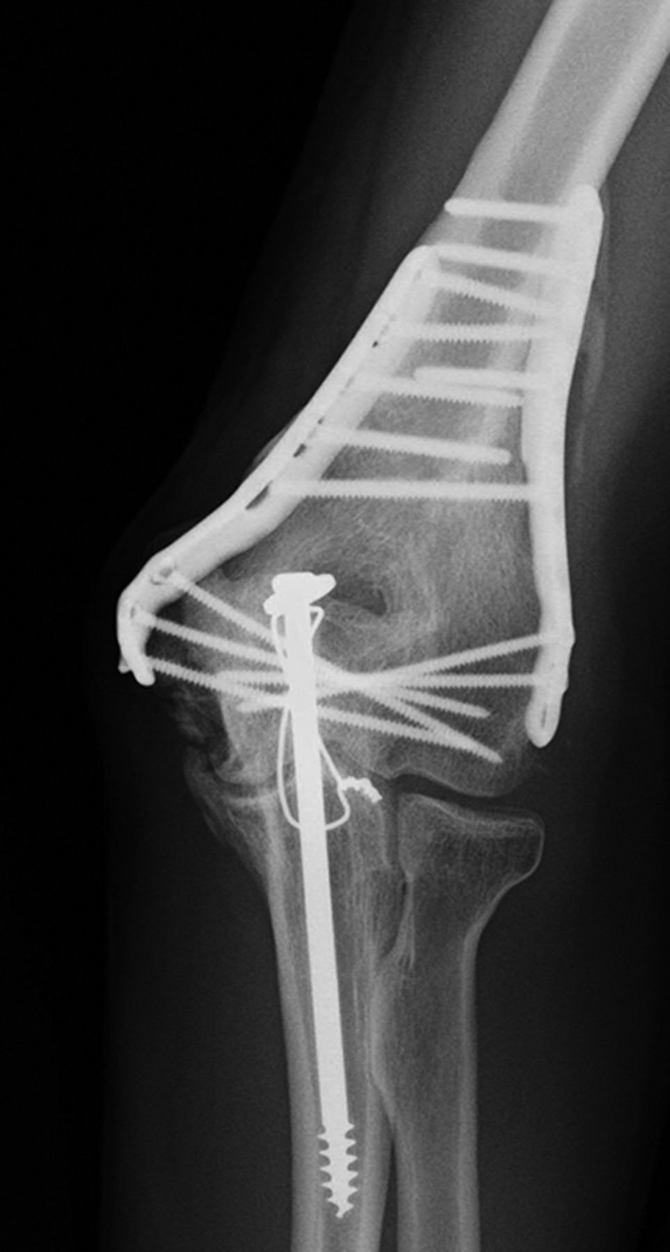 Heterotopic Ossification After Surgery For Distal Humeral Fractures ...