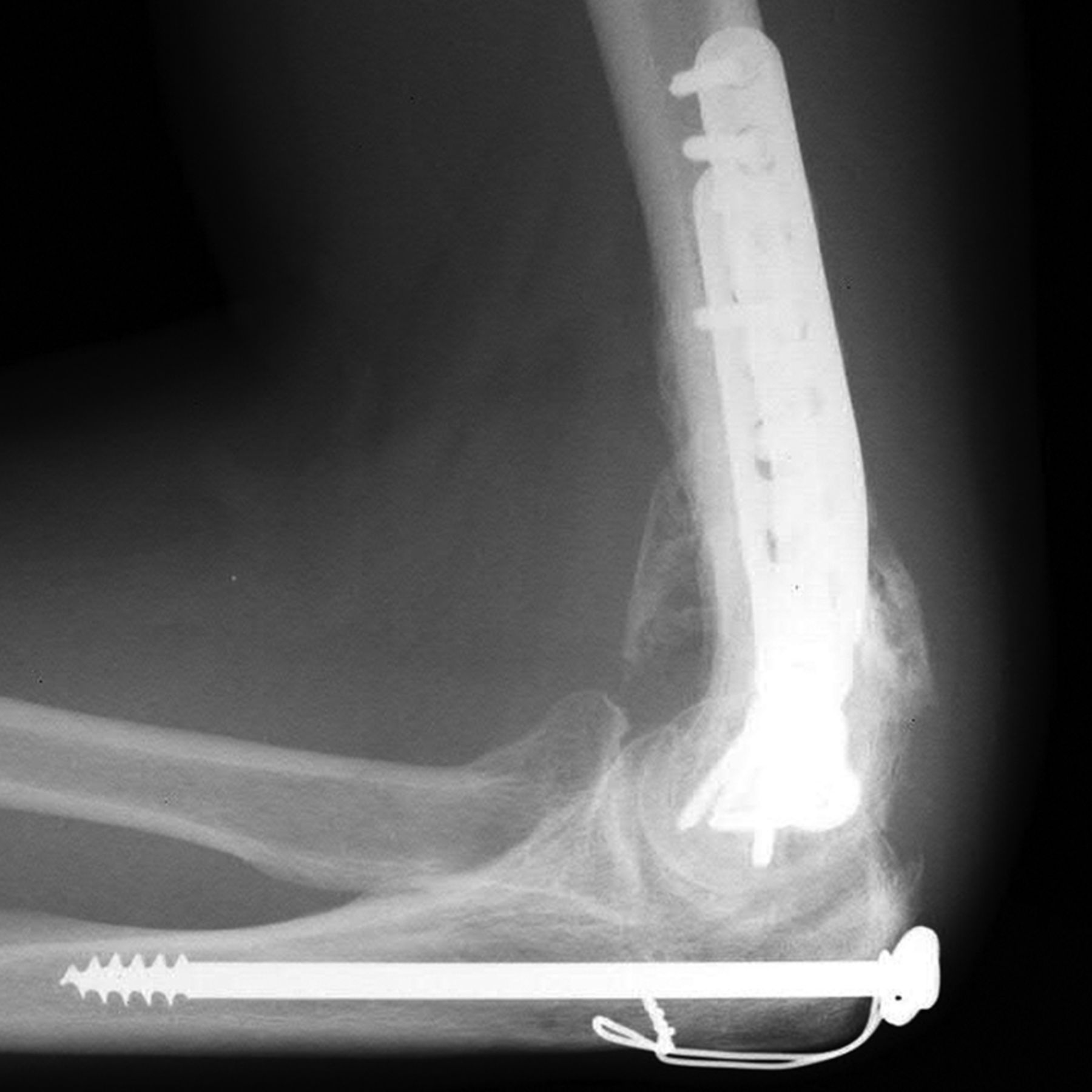 Heterotopic Ossification After Surgery For Distal Humeral Fractures Bone And Joint