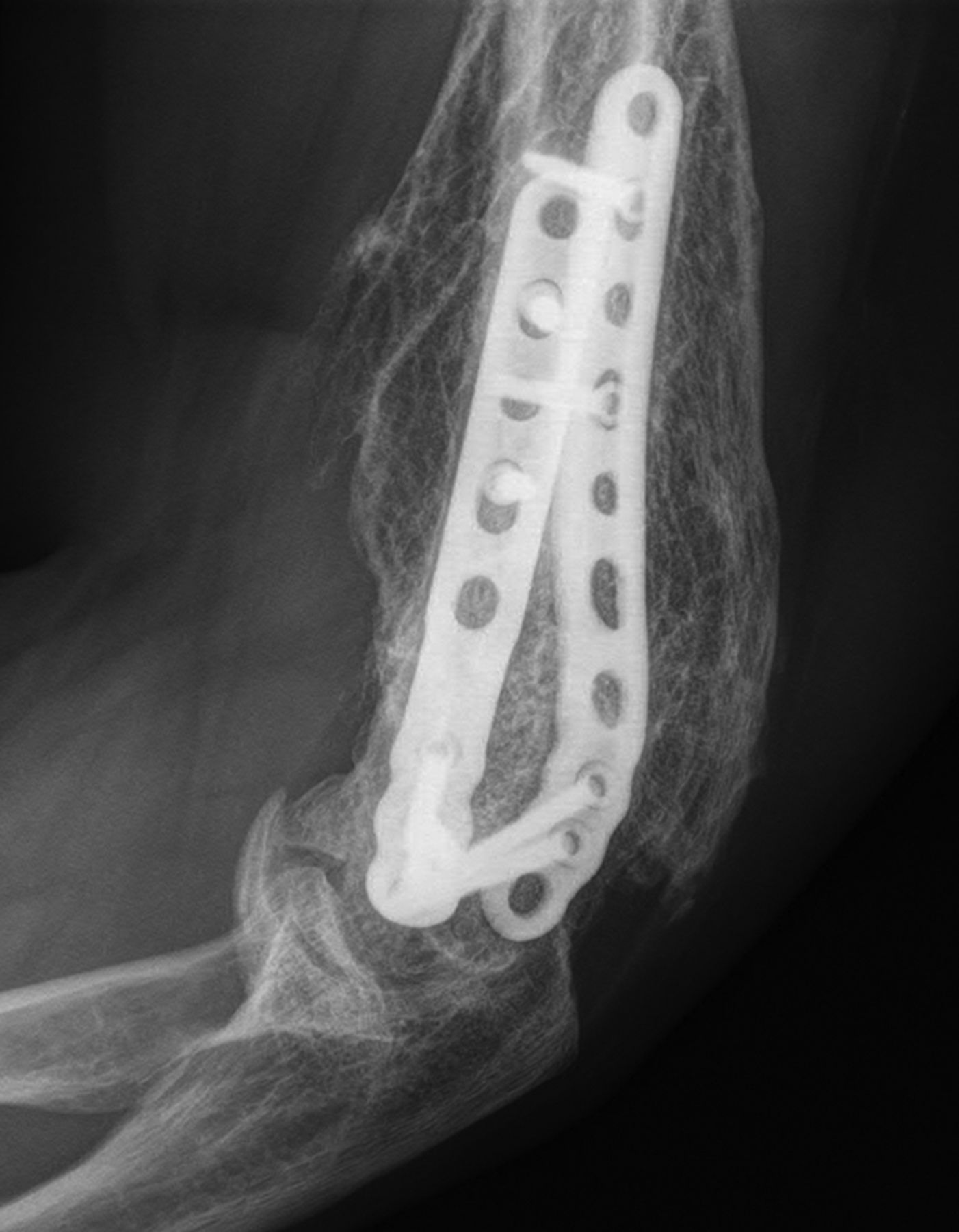 Heterotopic Ossification After Surgery For Distal Humeral Fractures