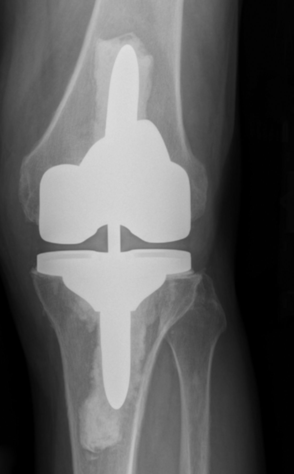 Stepwise surgical correction of instability in flexion after total knee ...