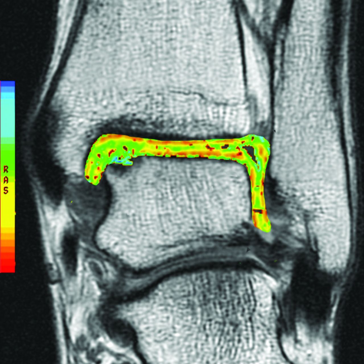 Osteochondral Lesions Of The Talus | Bone & Joint