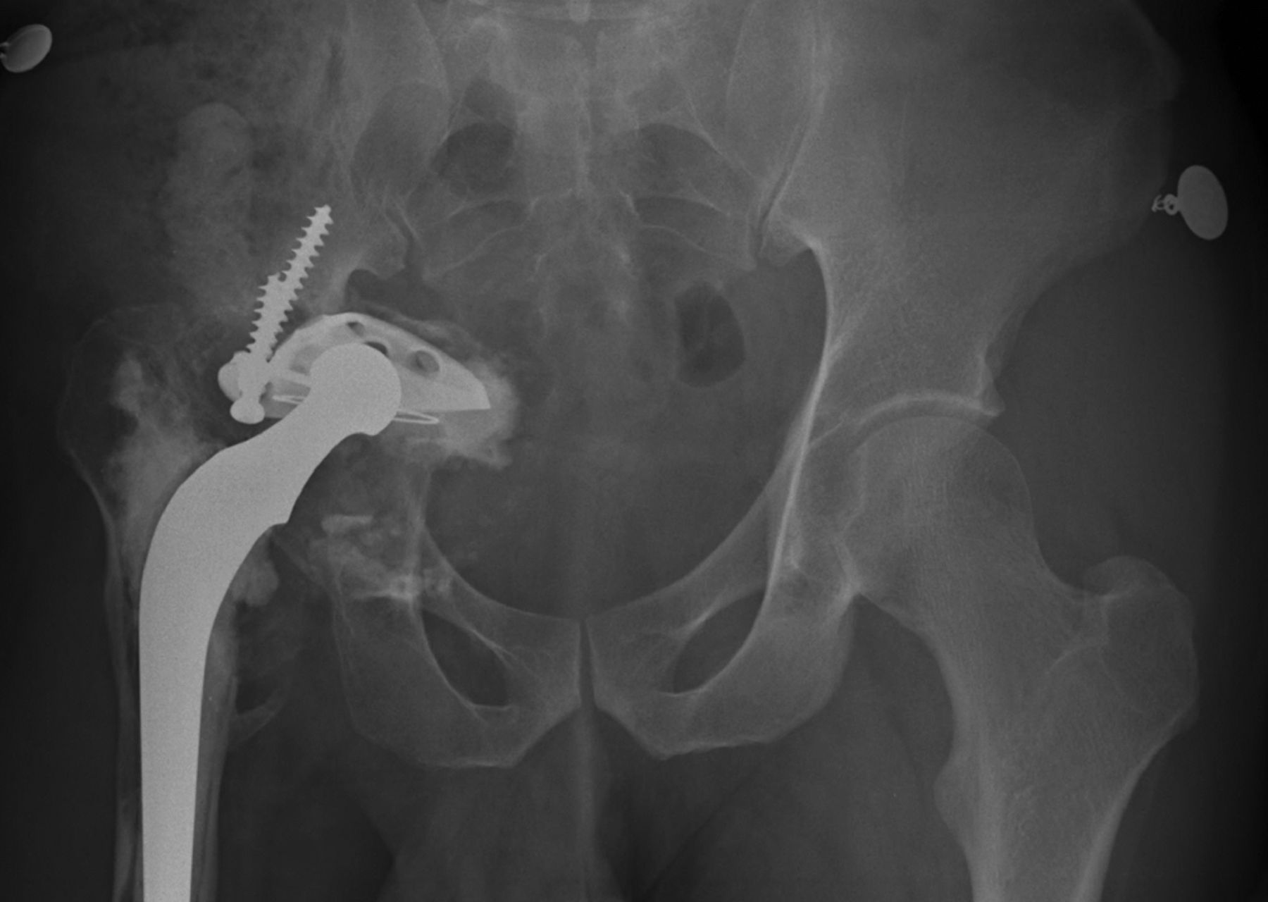 The challenge of pelvic discontinuity | Bone & Joint