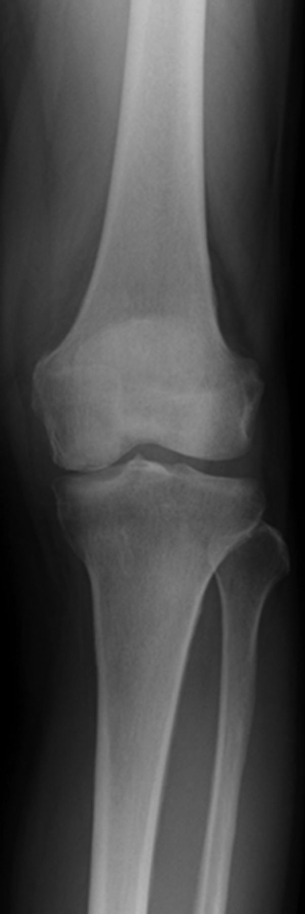 Five- to ten-year outcome following medial opening-wedge high tibial ...