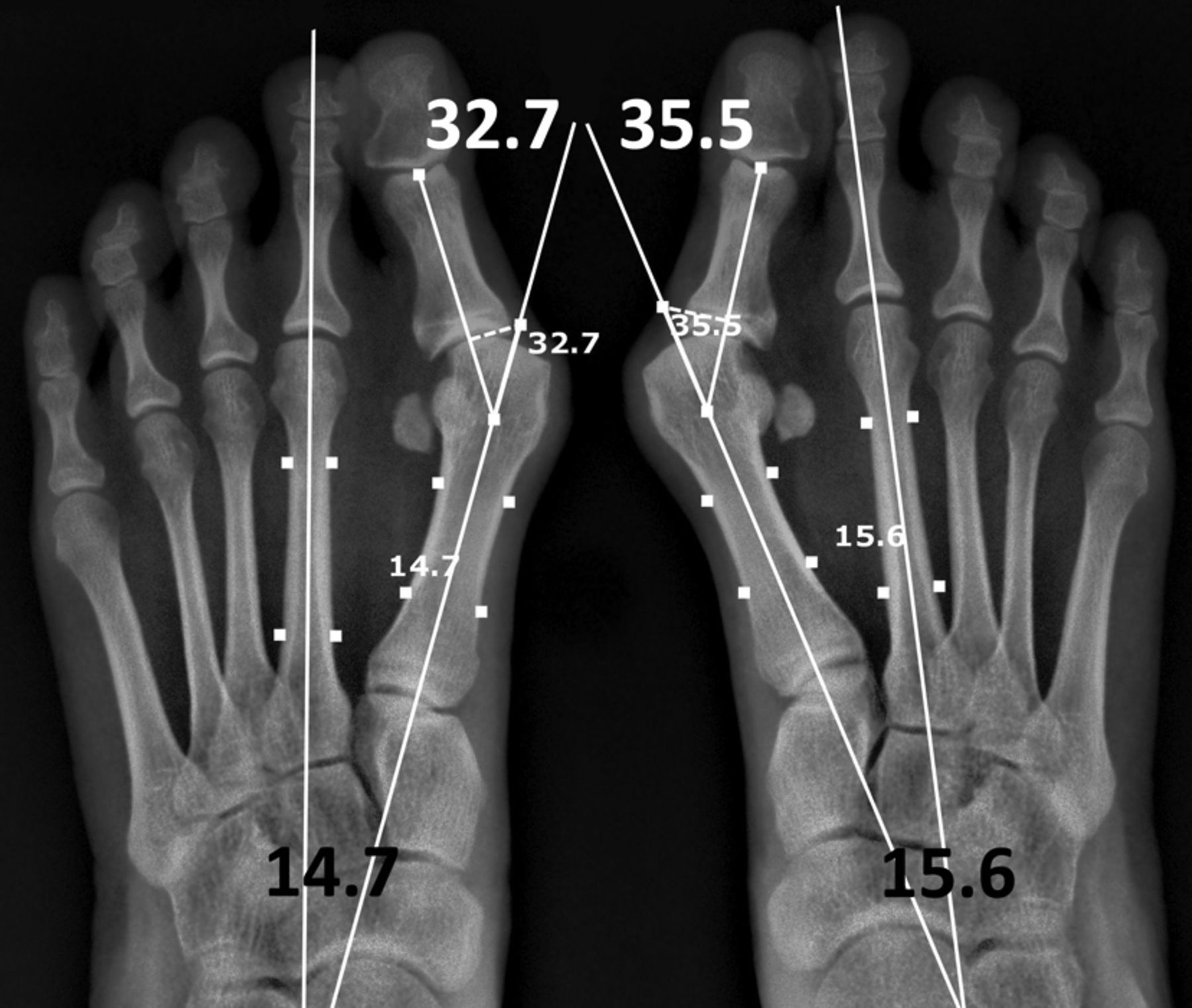 The Use Of A Syndesmosis Procedure For The Treatment Of Hallux Valgus