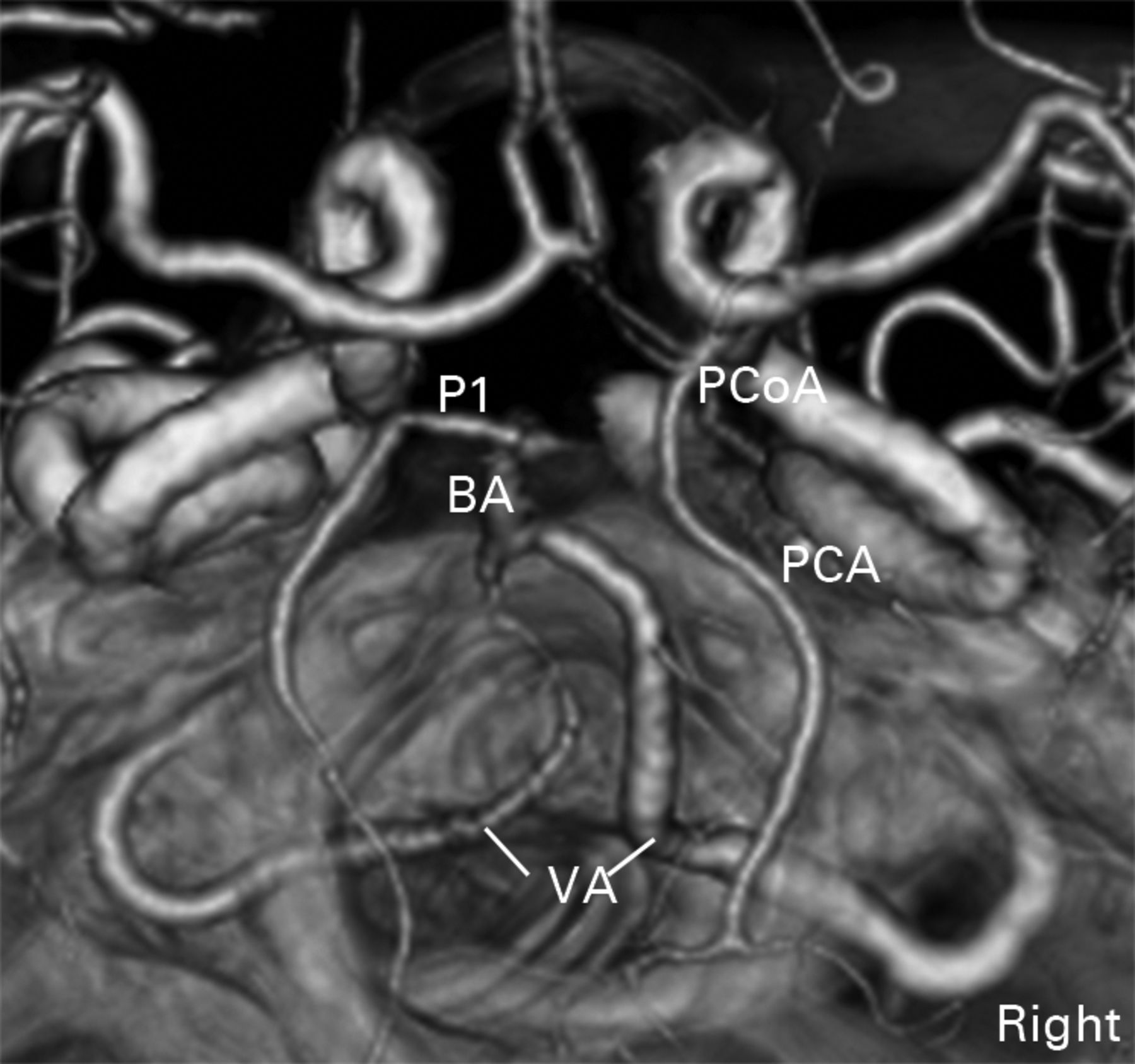 Anomalous Vertebral And Posterior Communicating Arteries As A Risk