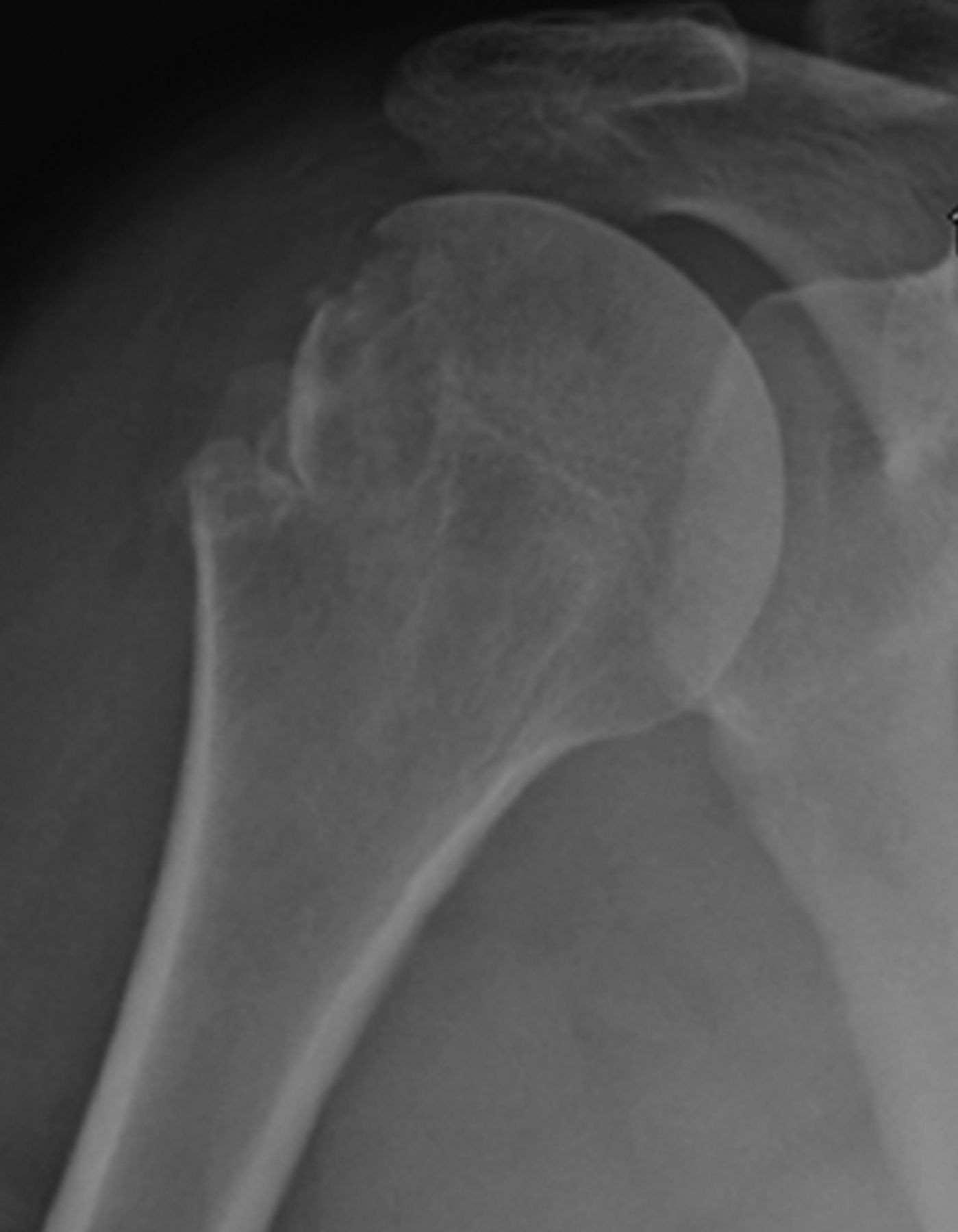 A new morphological classification for greater tuberosity fractures of ...