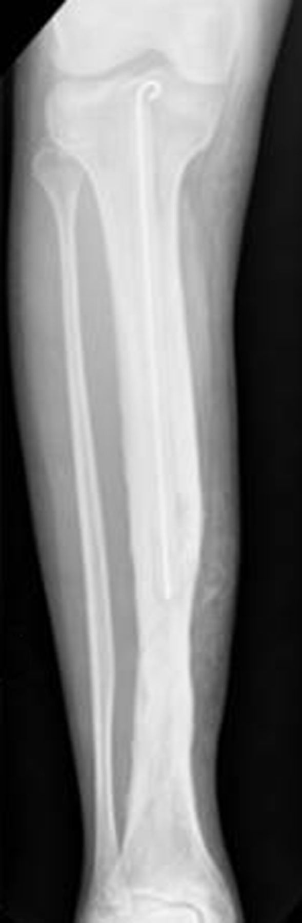 Discover more than 105 antibiotic nail femur latest - ceg.edu.vn