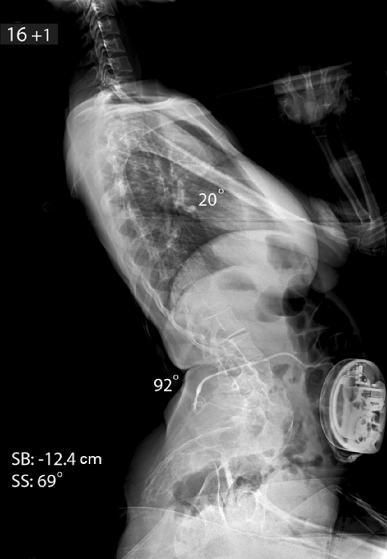 The Surgical Treatment Of Lordoscoliosis And Hyperlordosis In Patients ...