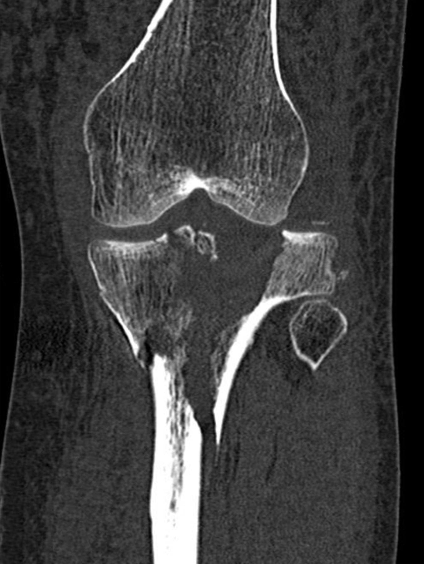 The outcome following fixation of bicondylar tibial plateau fractures ...