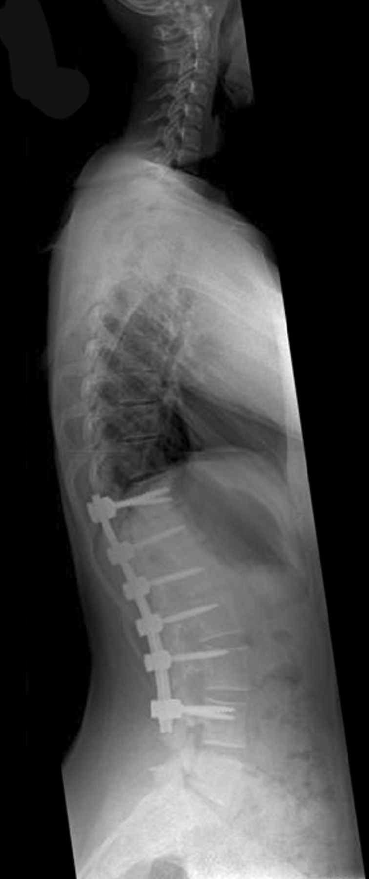 Posterior Spinal Fusion For Adolescent Idiopathic Thoracolumbarlumbar Scoliosis Bone And Joint 5071