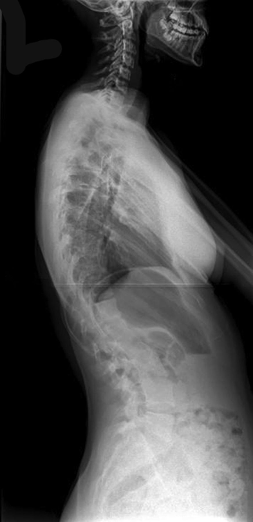 Posterior spinal fusion for adolescent idiopathic thoracolumbar/lumbar ...