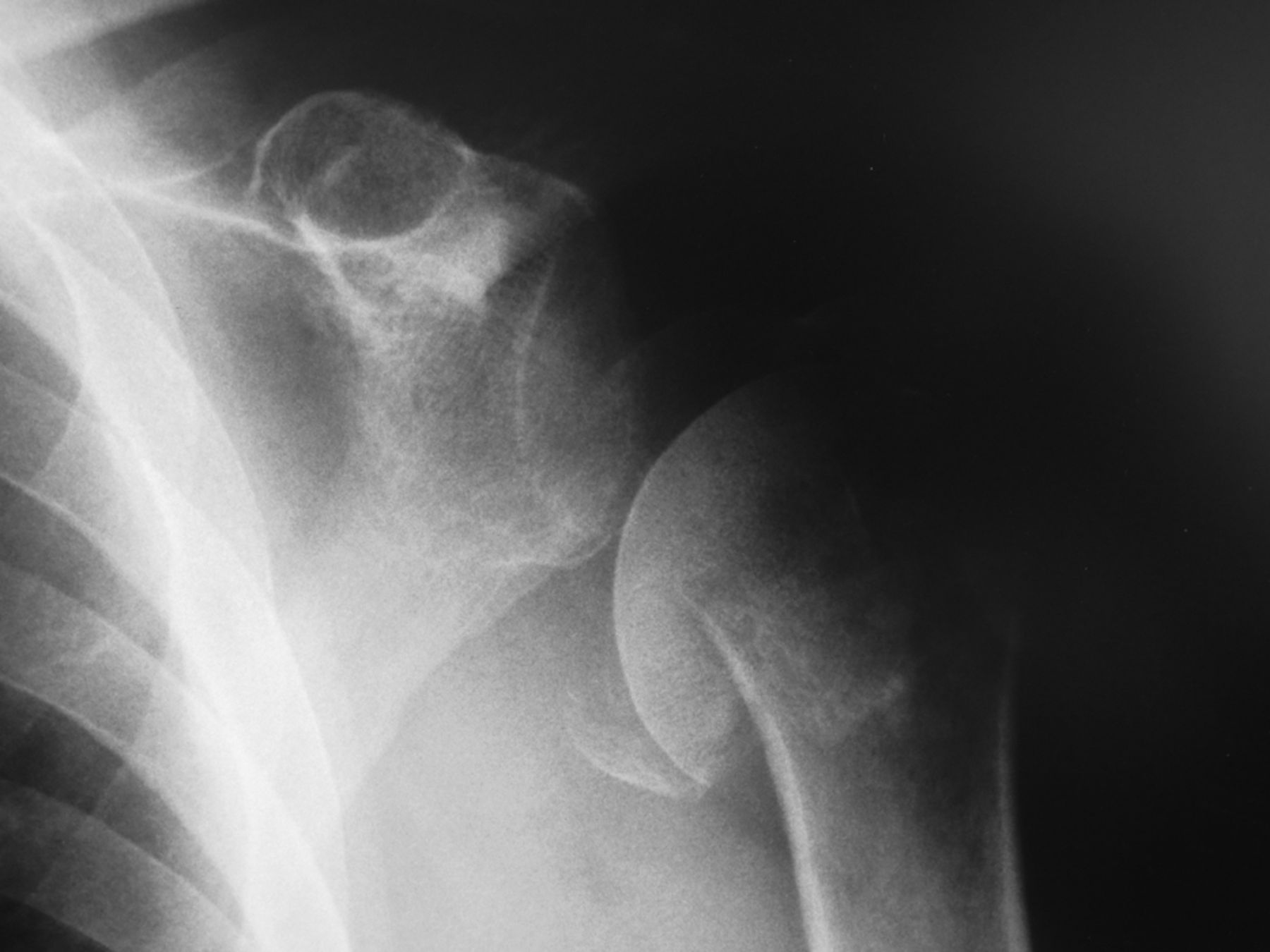 Reverse total shoulder replacement for nonunion of a fracture of the ...