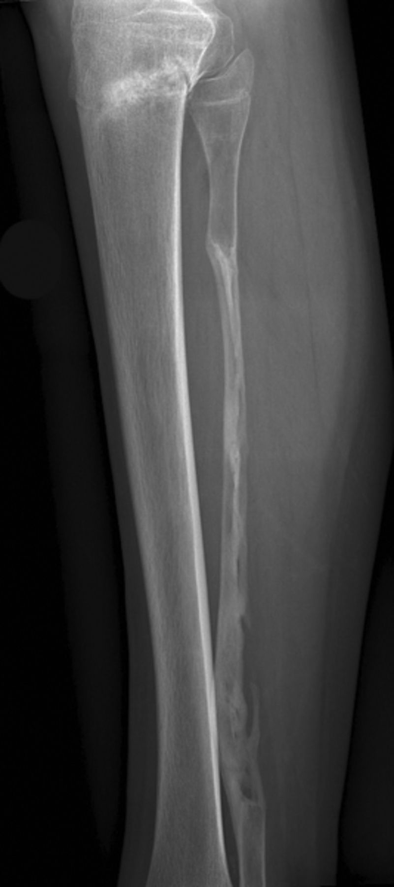 Vascularised or non-vascularised autologous fibular grafting for the ...