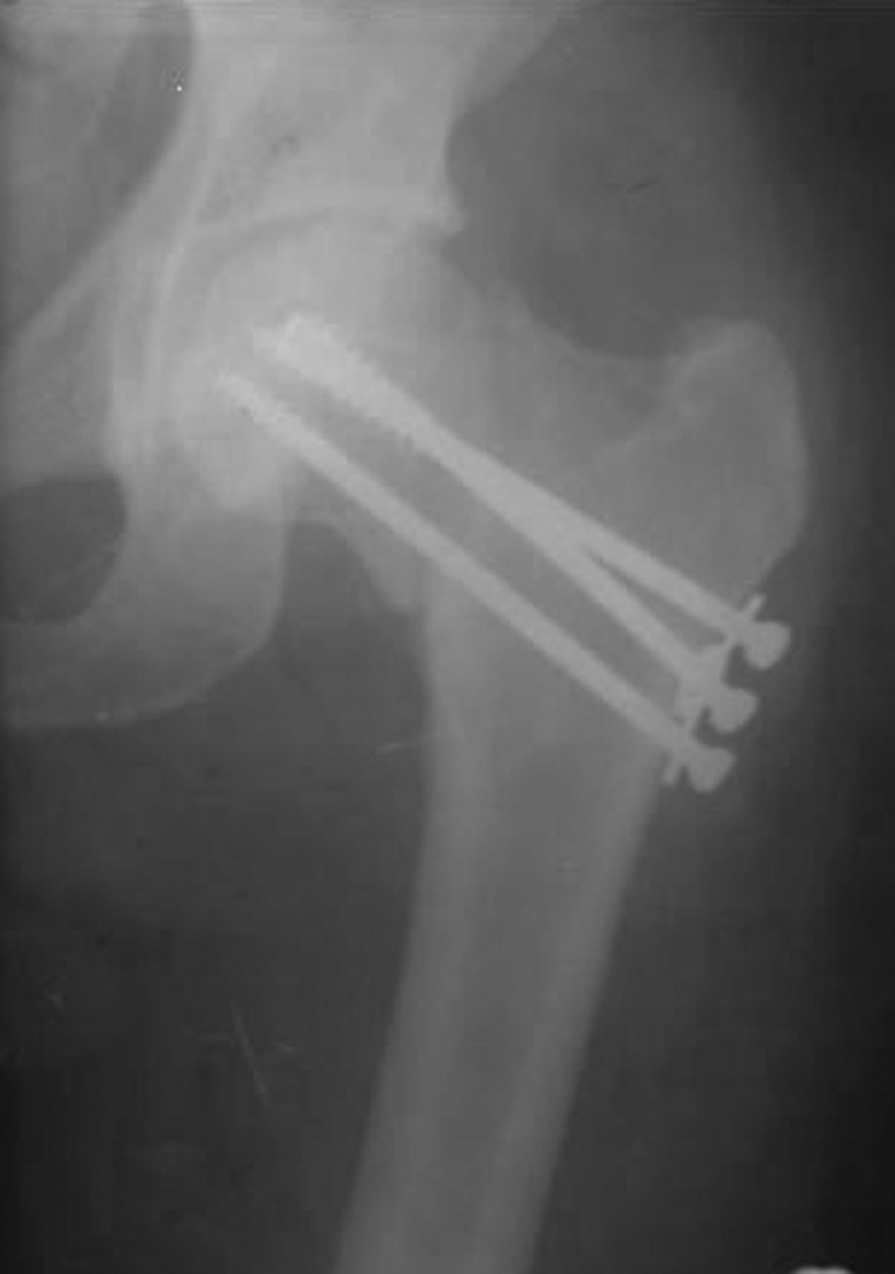 Modified Pauwels’ intertrochanteric osteotomy in the management of ...