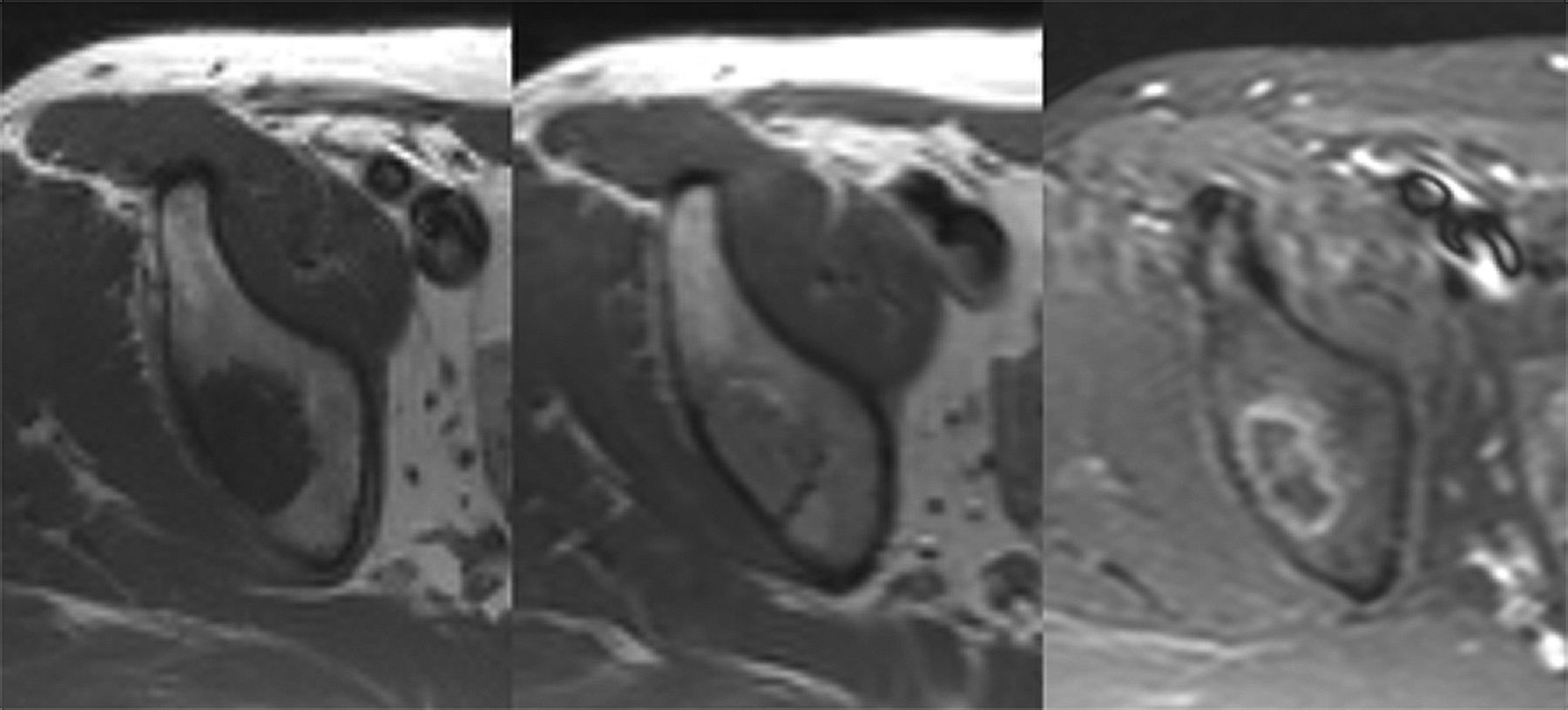 The Mri Appearances Of Cancellous Allograft Bone Chips After The 