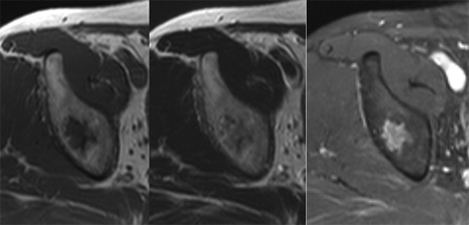 The Mri Appearances Of Cancellous Allograft Bone Chips After The 