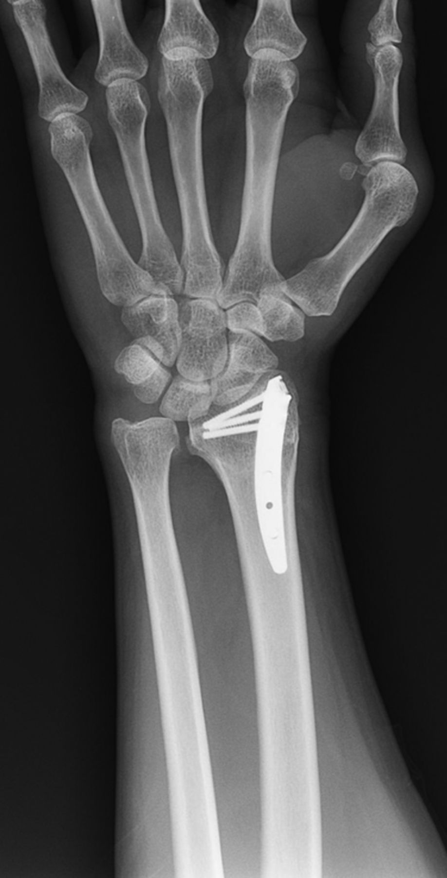 Defining The Role Of Intramedullary Nailing For Fractures Of The Distal ...