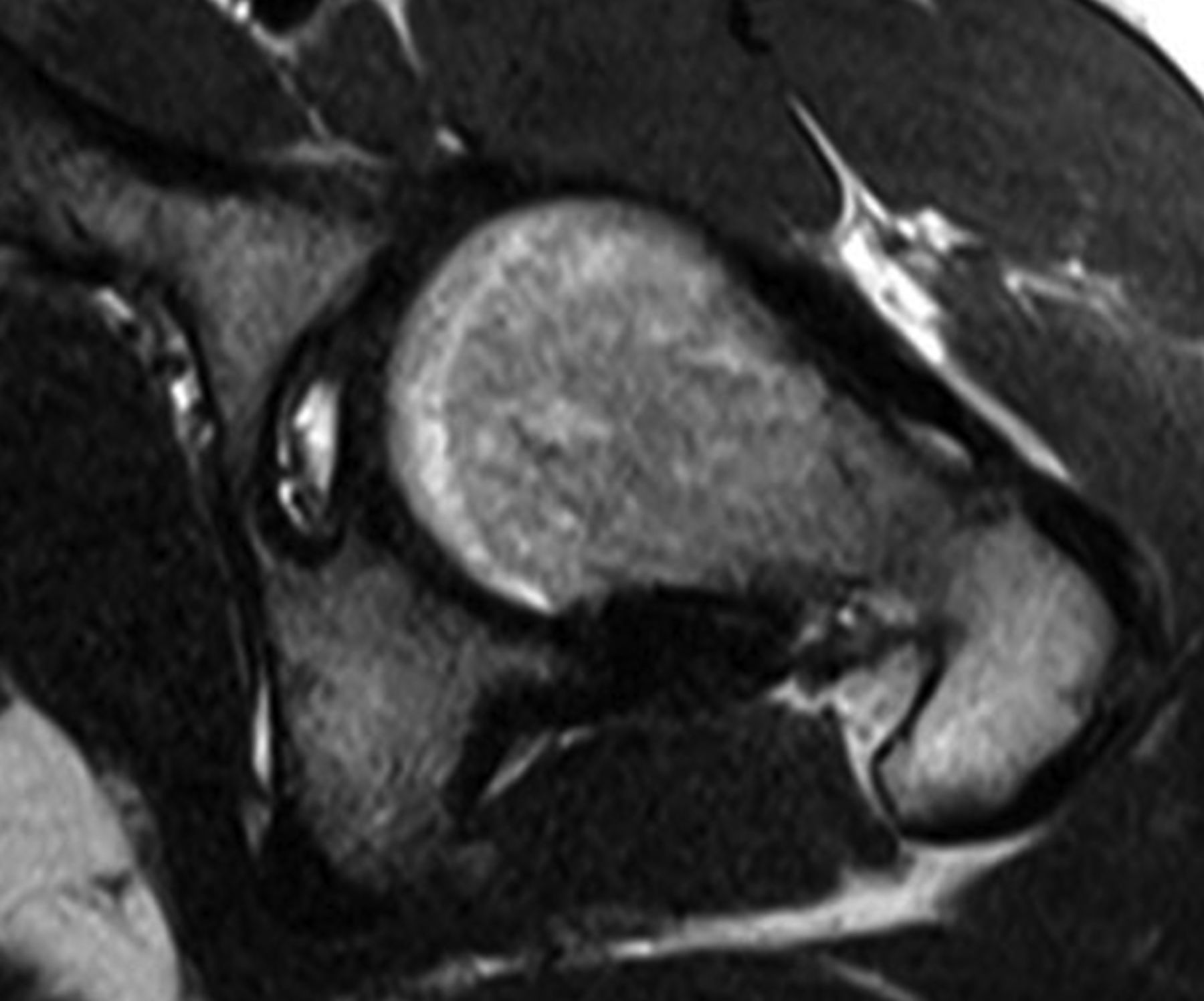 Arthroscopy Of The Hip For Patients With Mild To Moderate Developmental ...