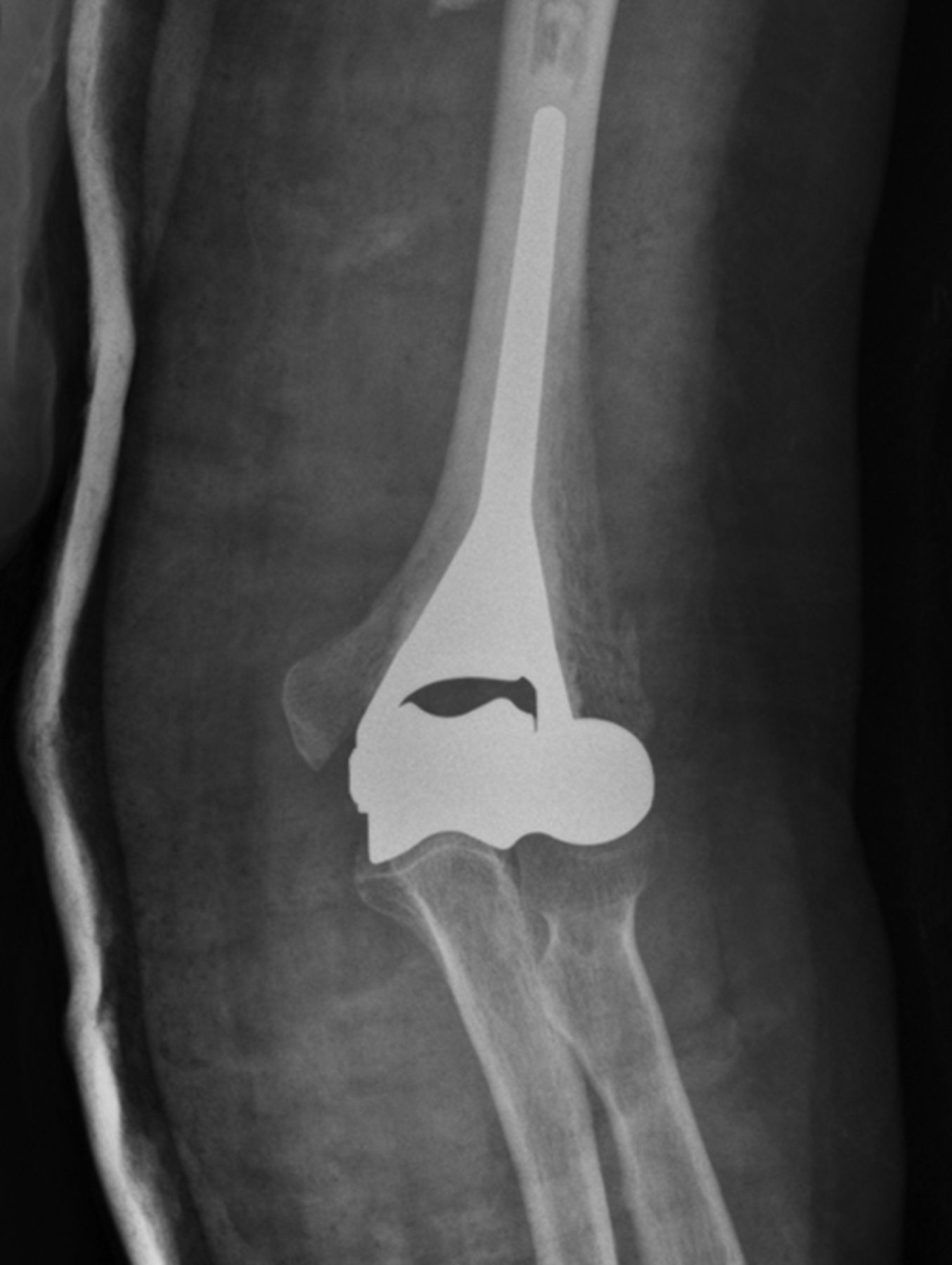 Hemiarthroplasty for irreparable distal humeral fractures | Bone & Joint